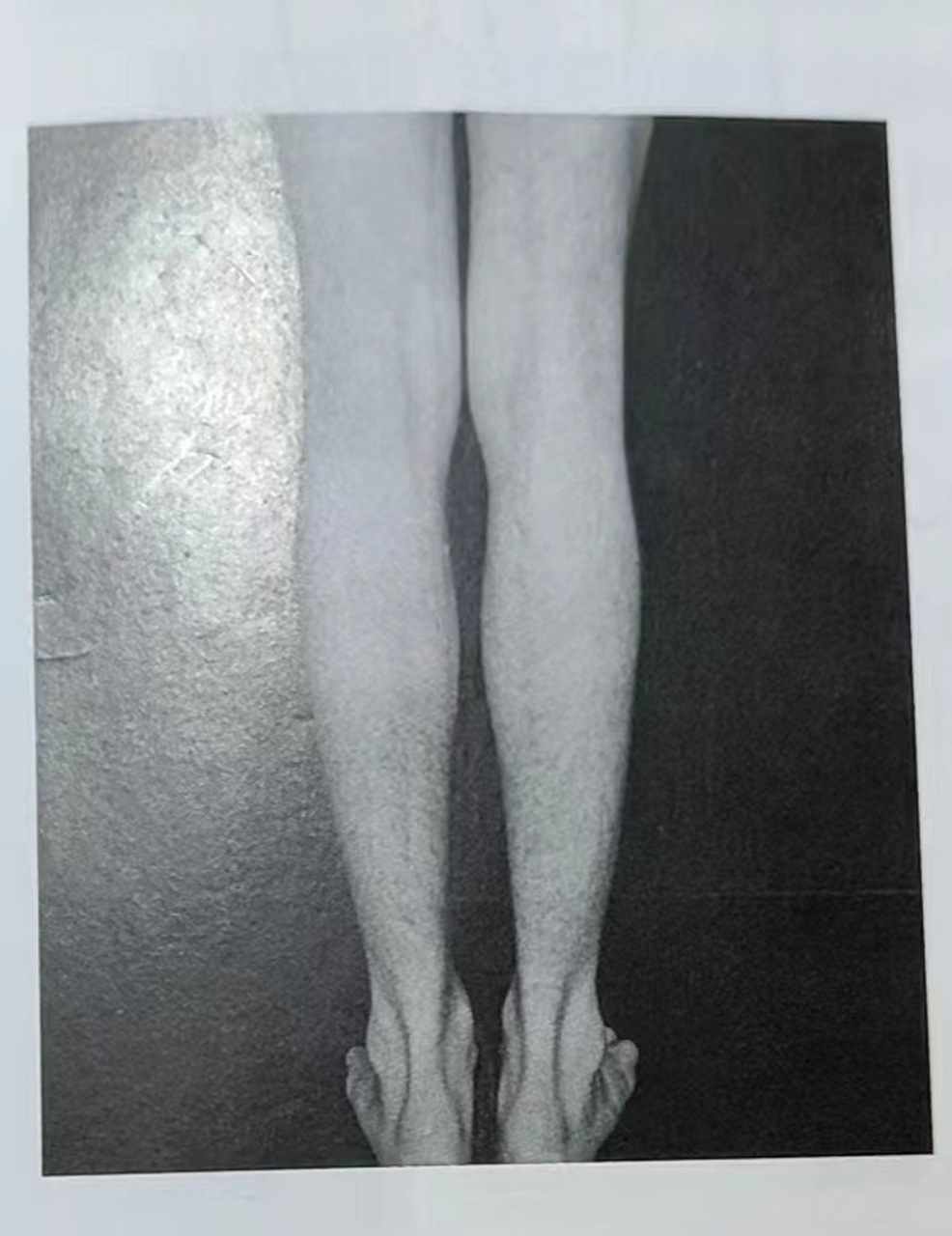 下肢力线:背面第一张 这个是相对比较良好的腿部和足部的排列,有人