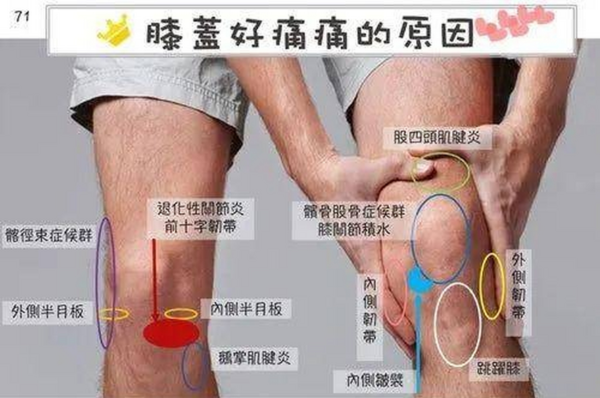 膝关节疼痛5——股四头肌肌腱炎: 它的疼痛更多的时候在我们的髌骨的