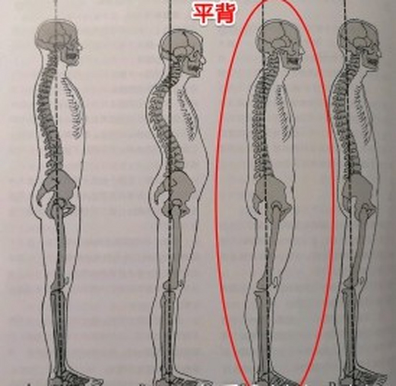 平背 正常人体的腰椎有一定的生理弧度,腰椎变平直,生理弧度消失