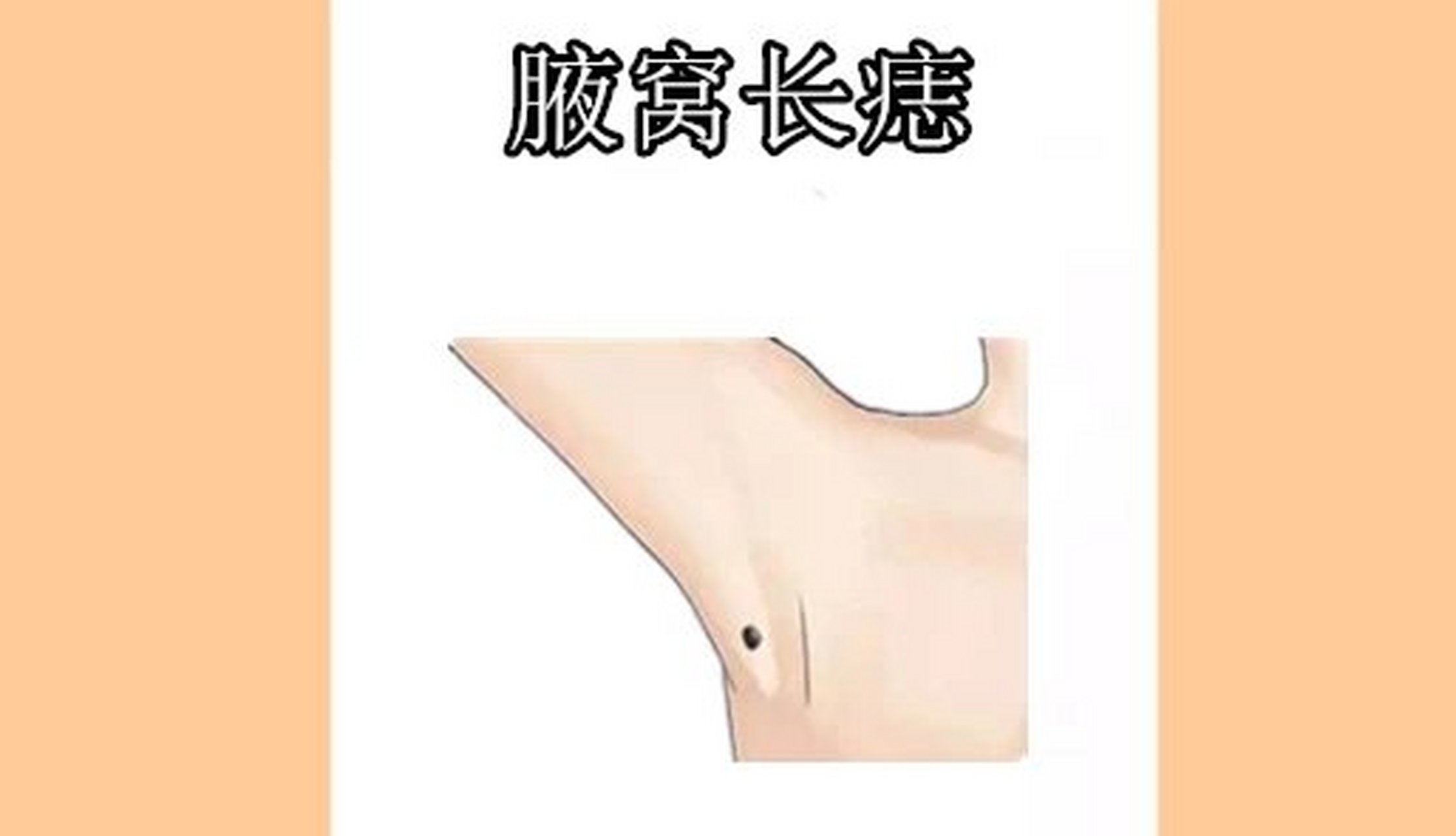 在相学当中,若是一个人的腋窝处的位置长有吉痣,则会被称之"金匮痣"