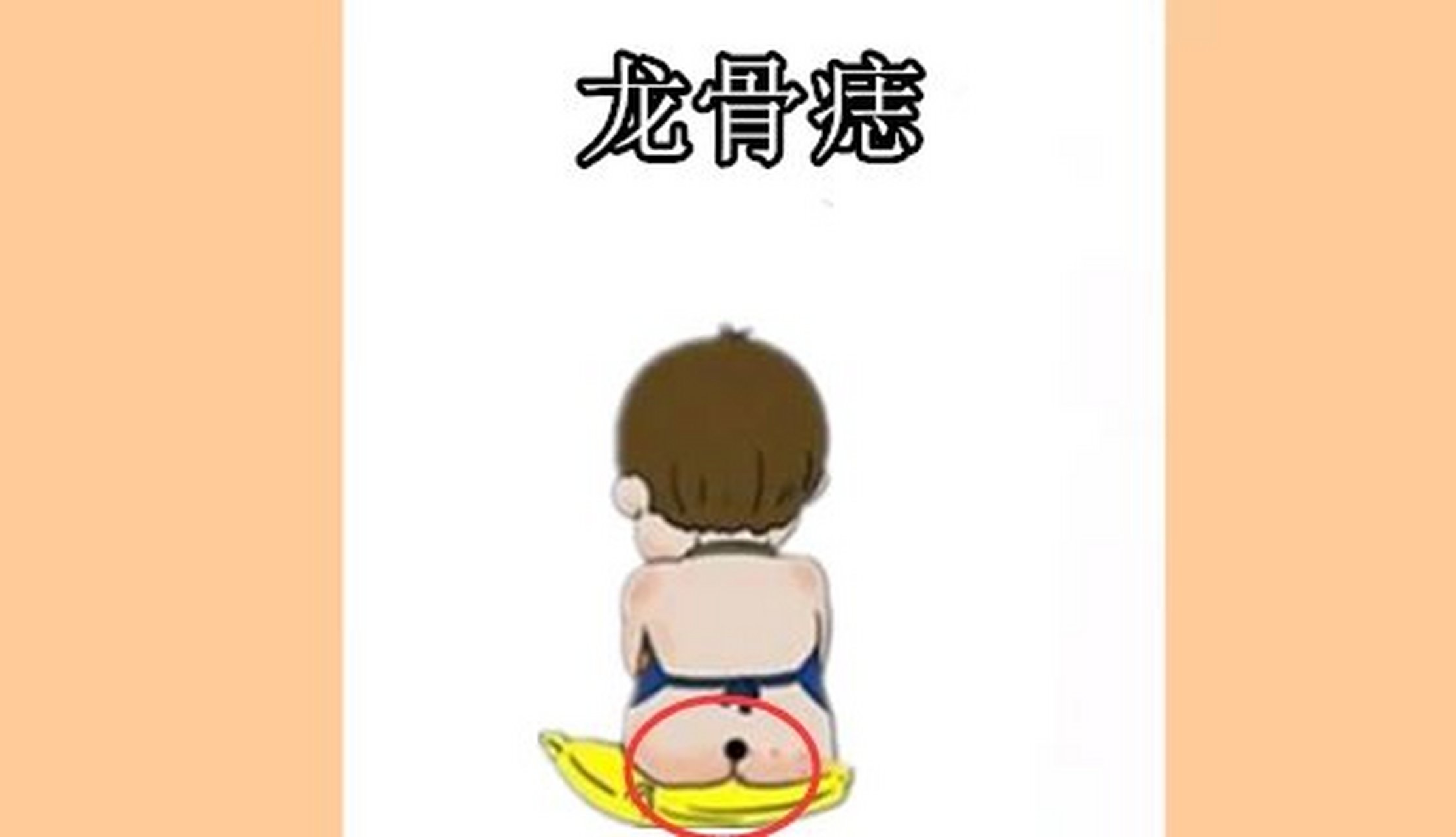 龙骨痣  这里所说的龙骨,就是我们的尾椎骨,若是在此处长有吉痣,多半