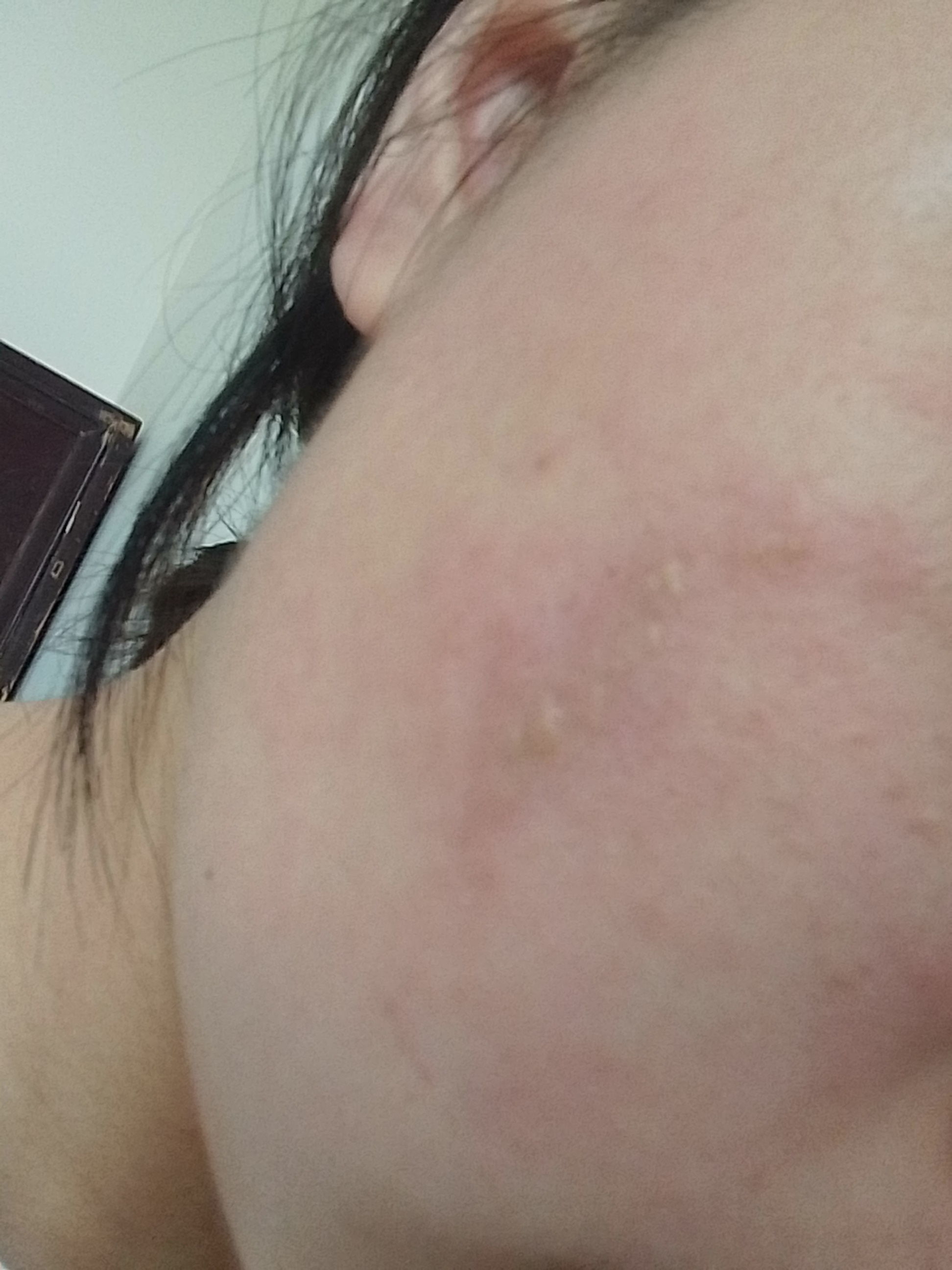 脸上长了个这个,摸一下就疼,这是怎么了[流泪][流泪][流泪]