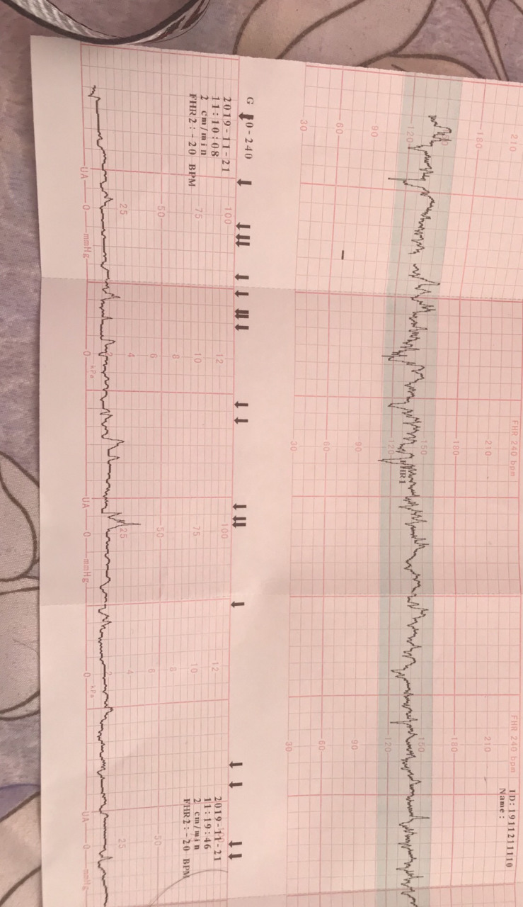 孕31周1天,胎心监护图,大家帮忙看看这是什么情况