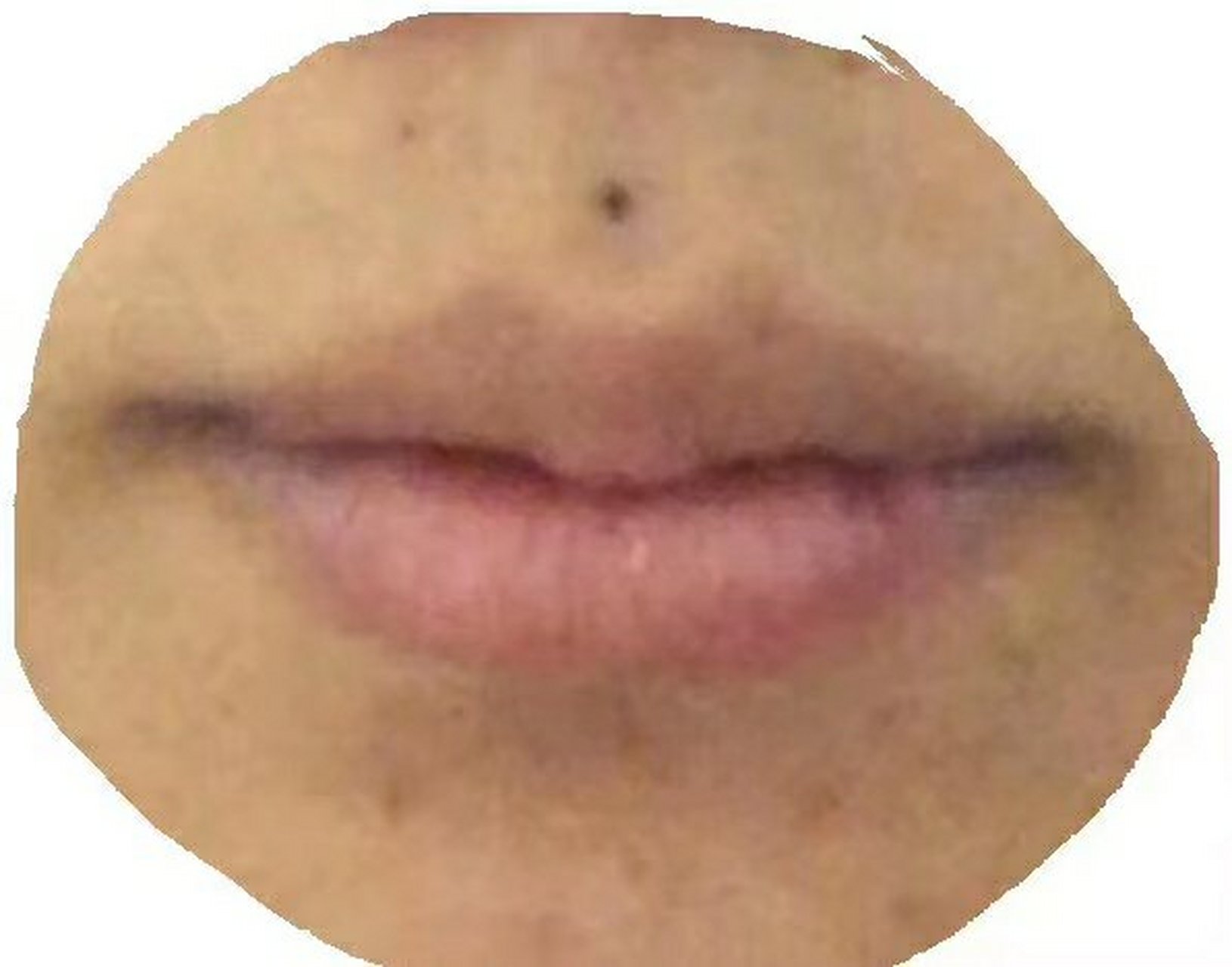 女人人中有痣,通常有生育困难情况发生,所以相书谓之产厄,另外一种