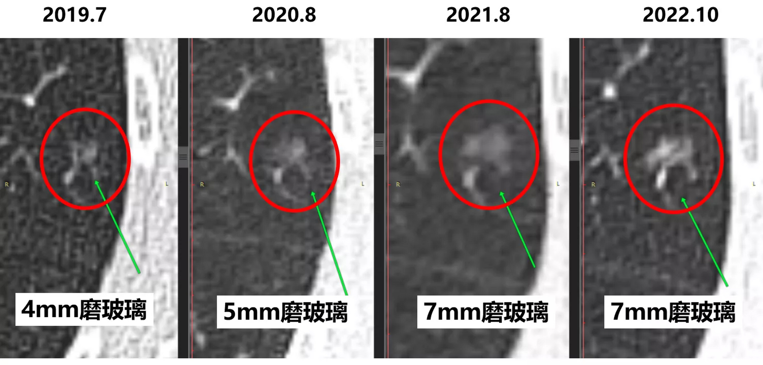 3-4mm磨玻璃肺結節發展成肺癌,需要多少年?