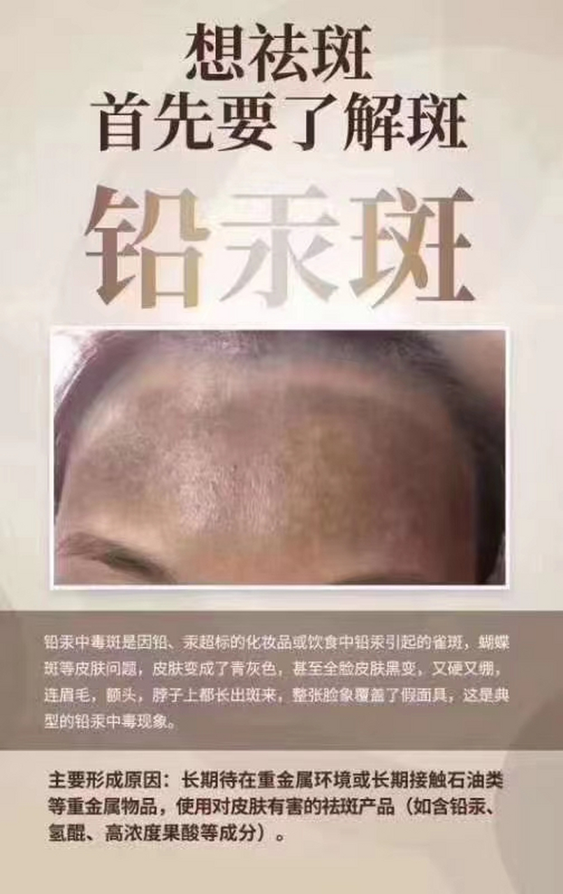 铅汞中毒斑 顾名思义是因为用过含铅汞等 重金属的化妆品而引起的斑