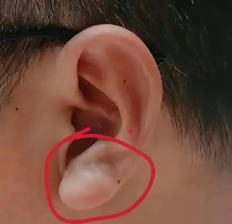 耳背沟的准确位置图片冠心沟图片看哪一个耳朵耳褶心征鉴别耳朵冠心沟