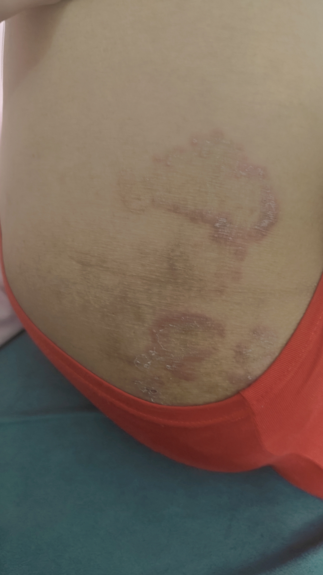 男朋友屁股下,大腿根部长这个,谁知道是什么啊?在线等
