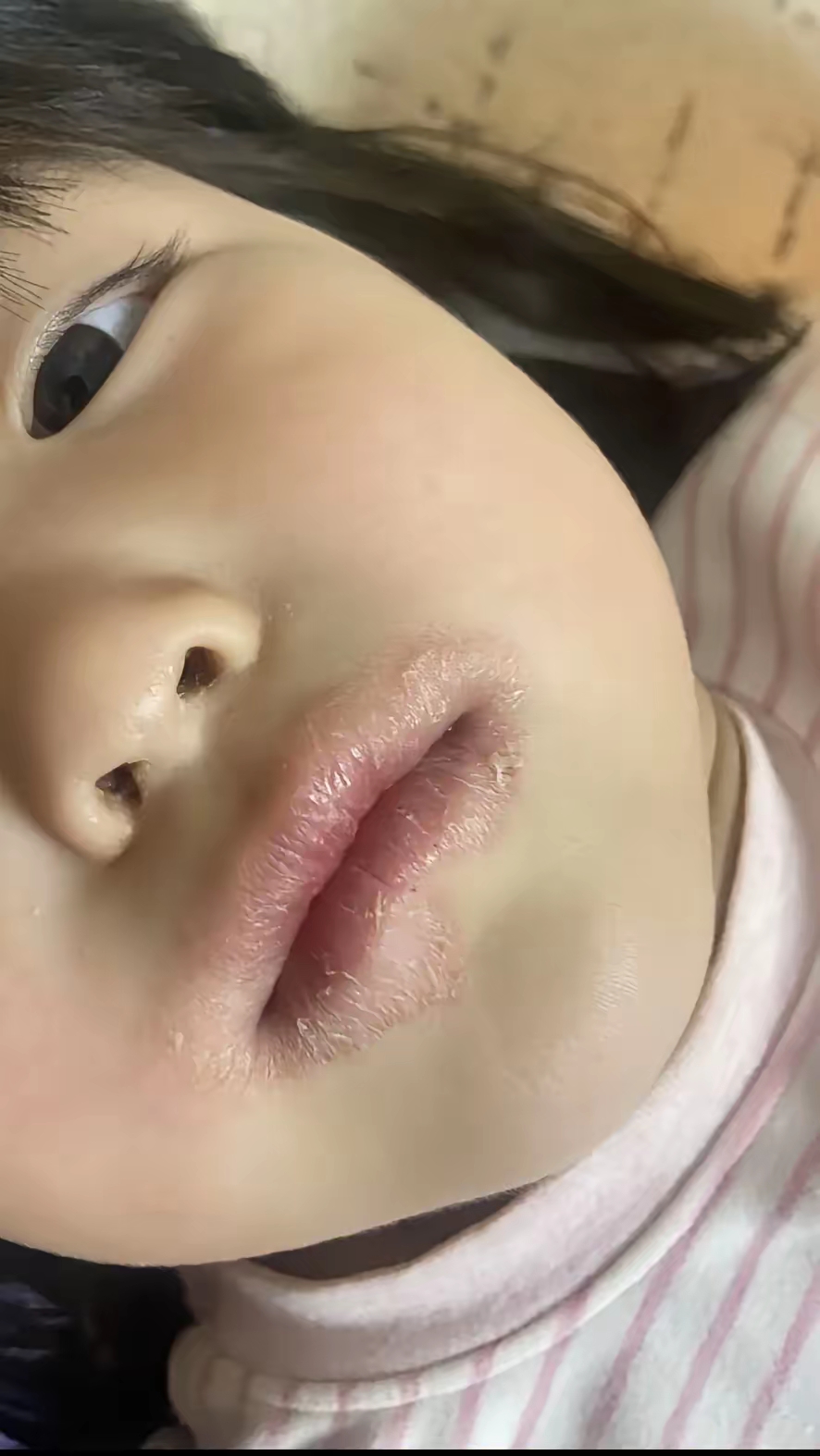 过敏性唇炎唇炎的图片小孩嘴边红红的像湿疹小孩口周皮炎图片宝宝唇炎