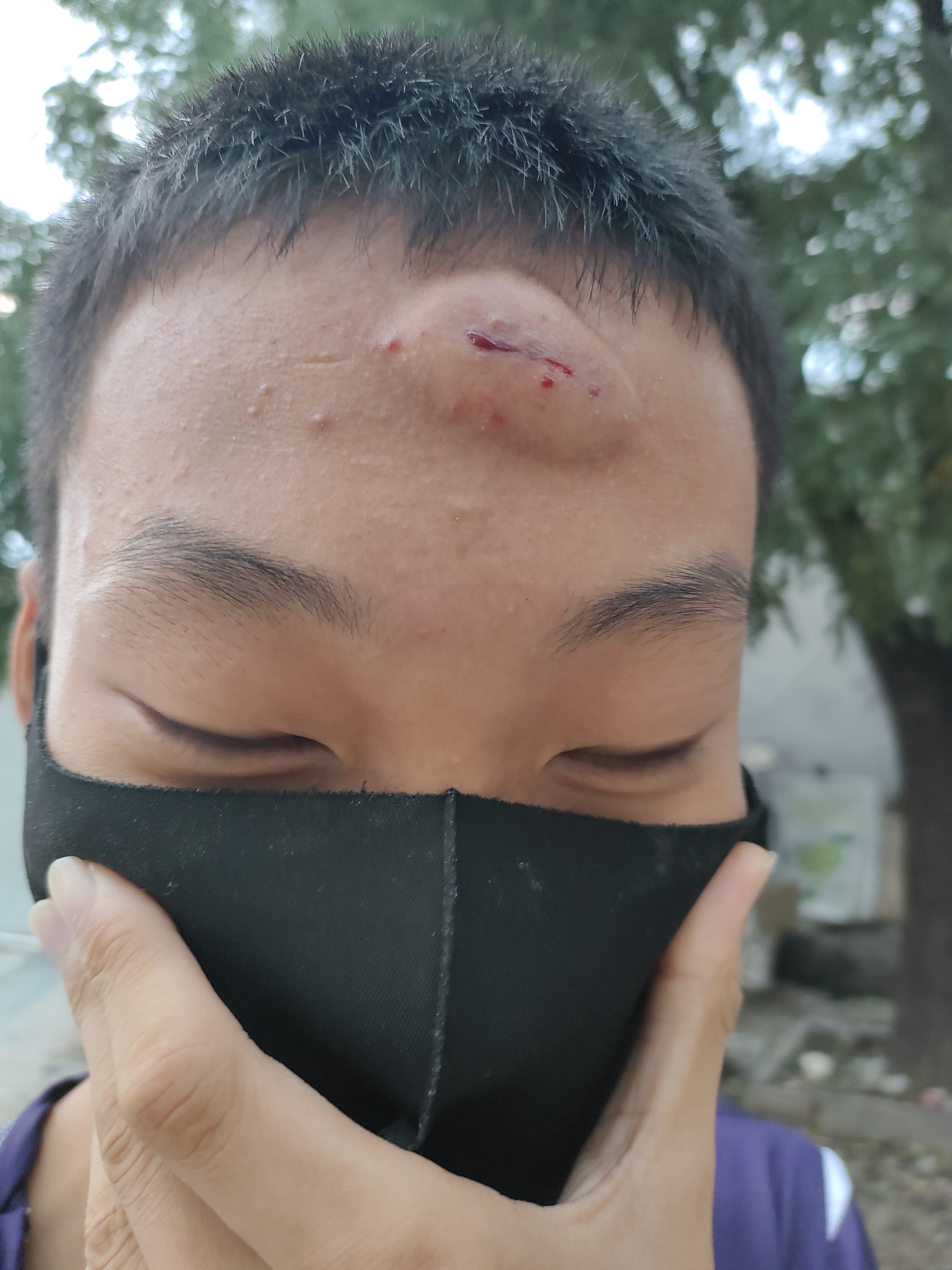 看看这个不省心的大儿子,头上磕了个大包,让老娘心疼死了!