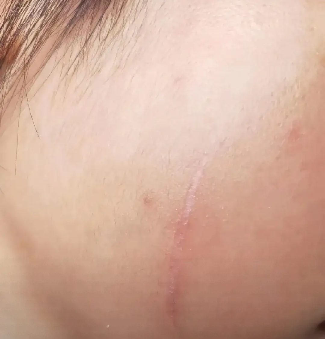 孩子受伤后,我们一直用完美芦荟胶给她擦脸