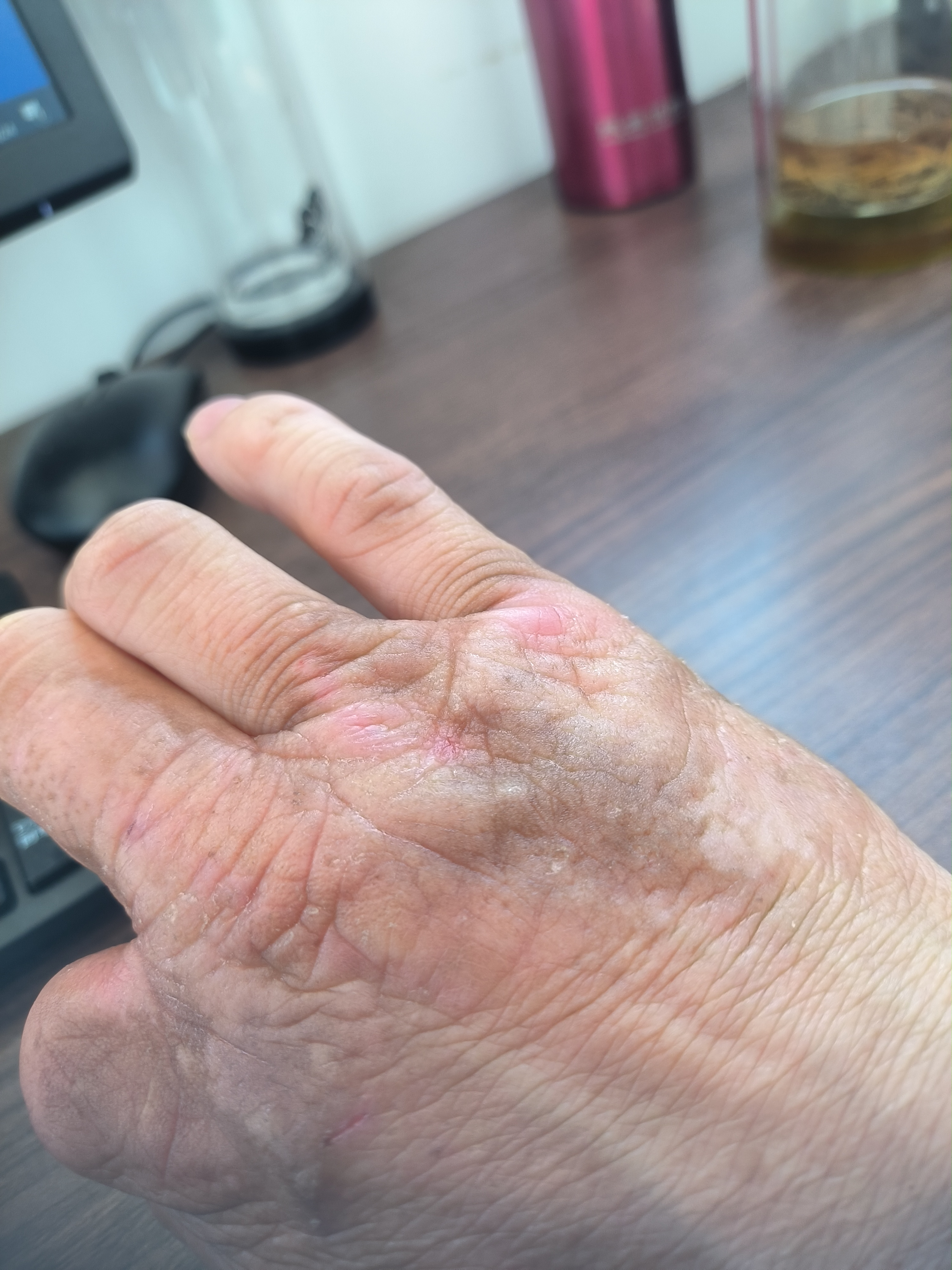 皮肤增厚结痂,裂口,还痒,好多年了,反反复复.始终无法除根