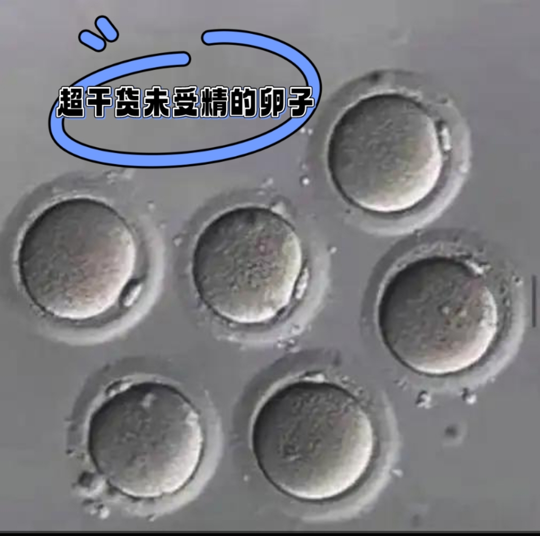 试管婴儿# 今天上班取卵后心里话 每个人的卵子个数都是从母亲怀孕时