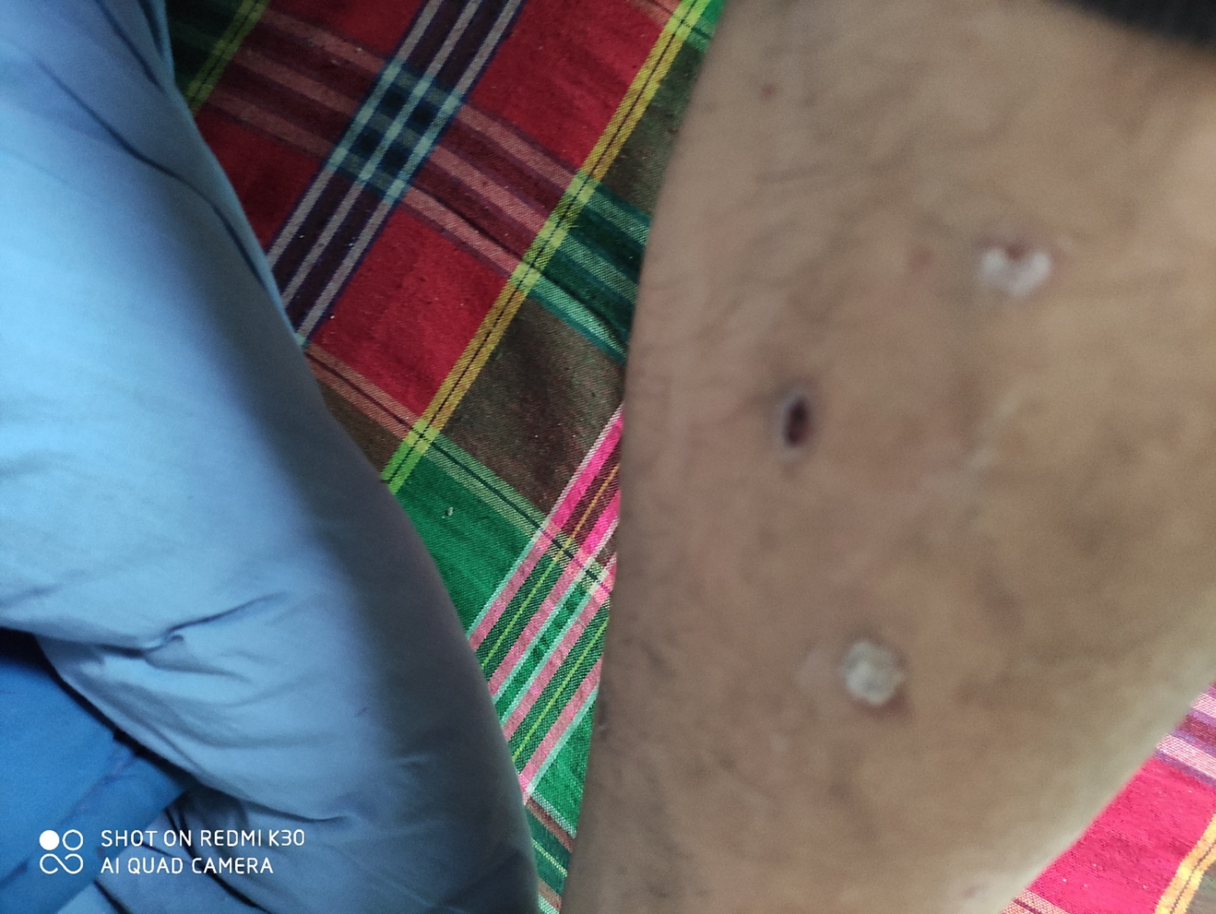 此图片是小腿部,什么皮肤癣,如何治,用药