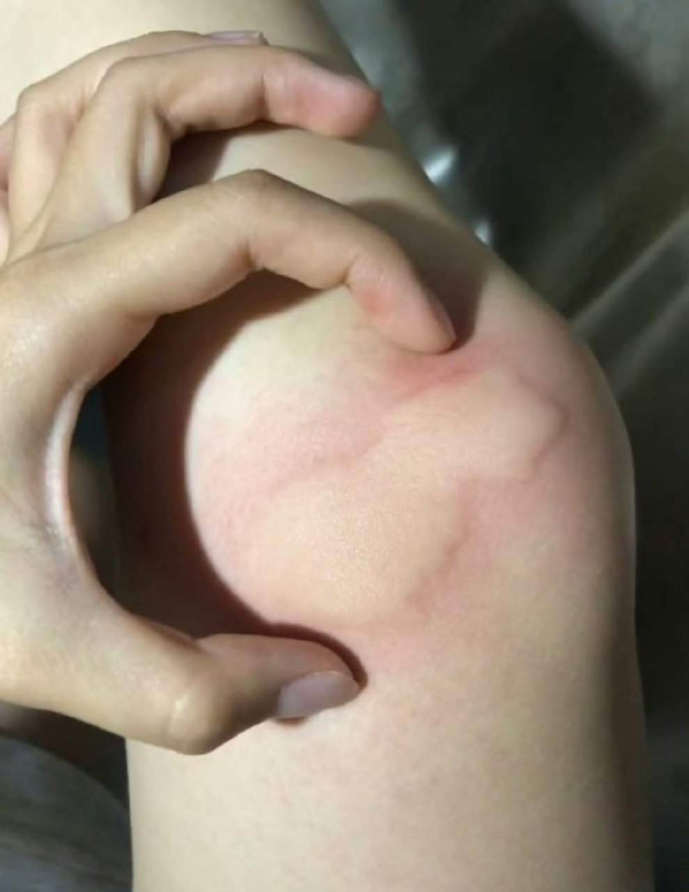 原来蚊子咬人这么厉害啊!