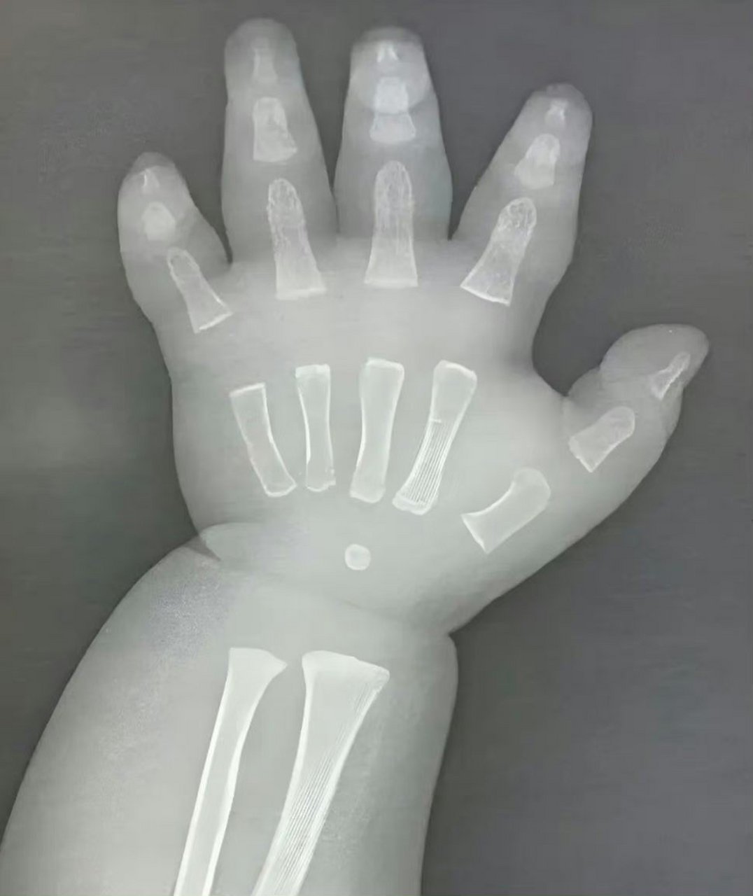 婴儿的手在x光下太可爱了,骨头都还没连在一起