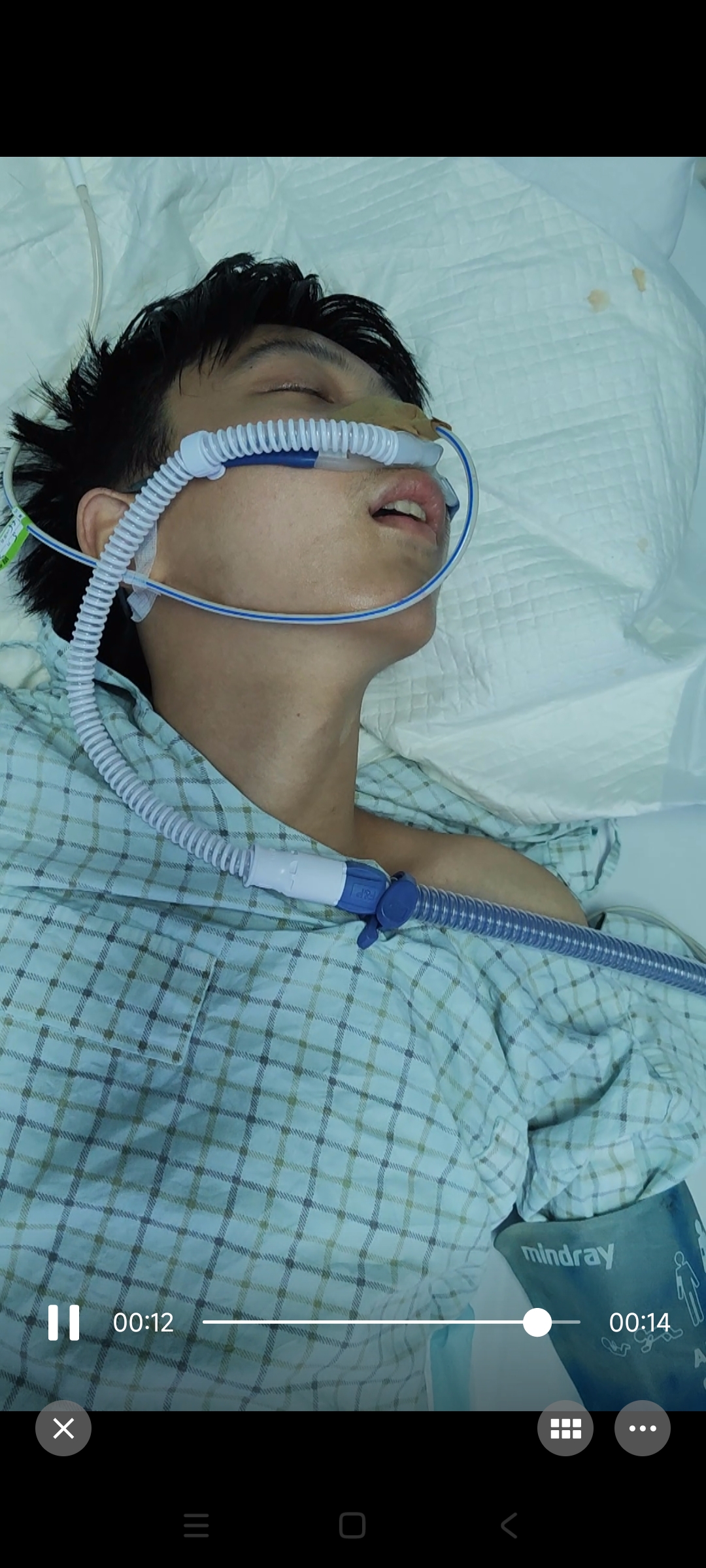 我小孩于五月23日在学校从宿舍楼摔下来,一度在重症监护室,今天才出来