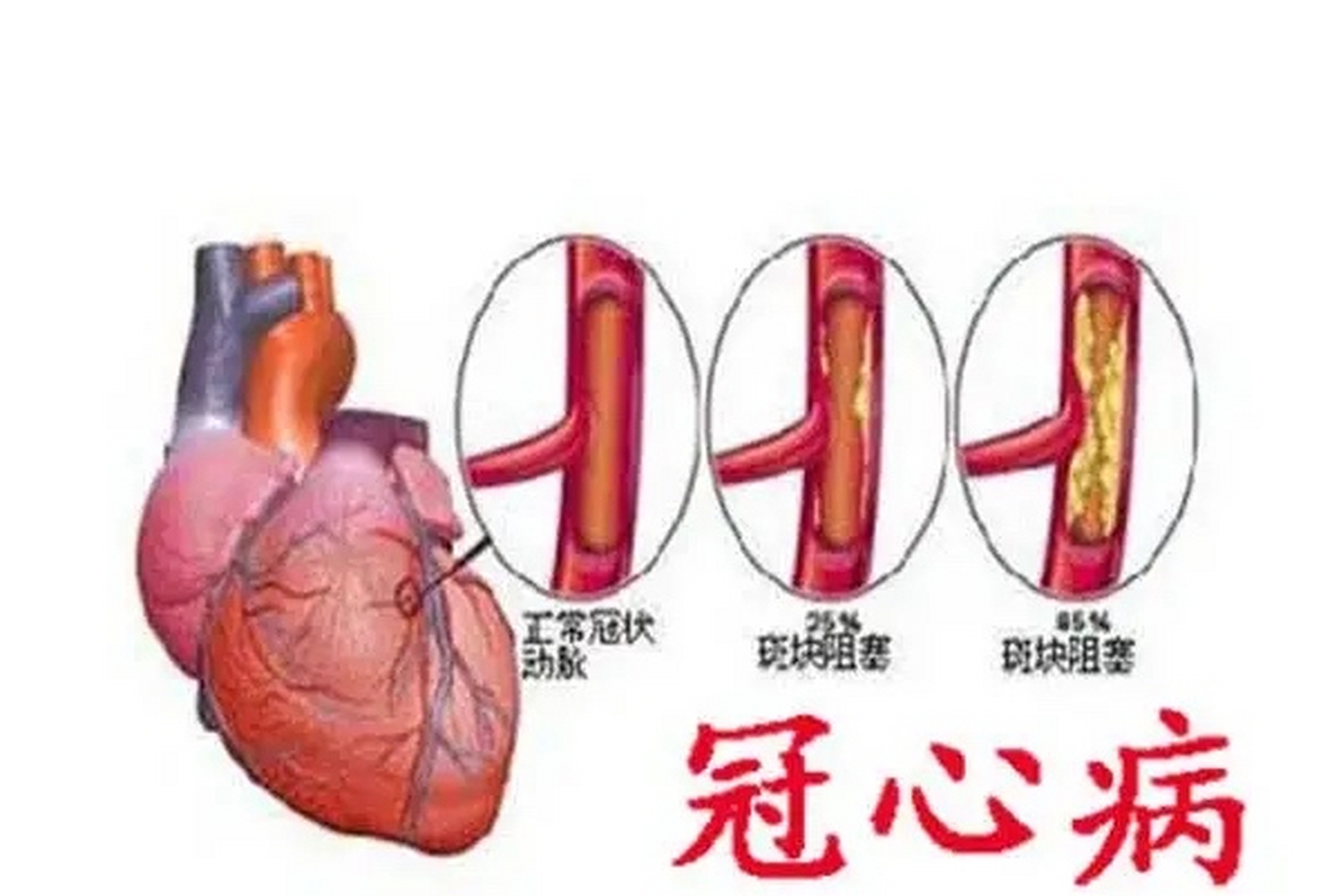 冠心病分类图片图片