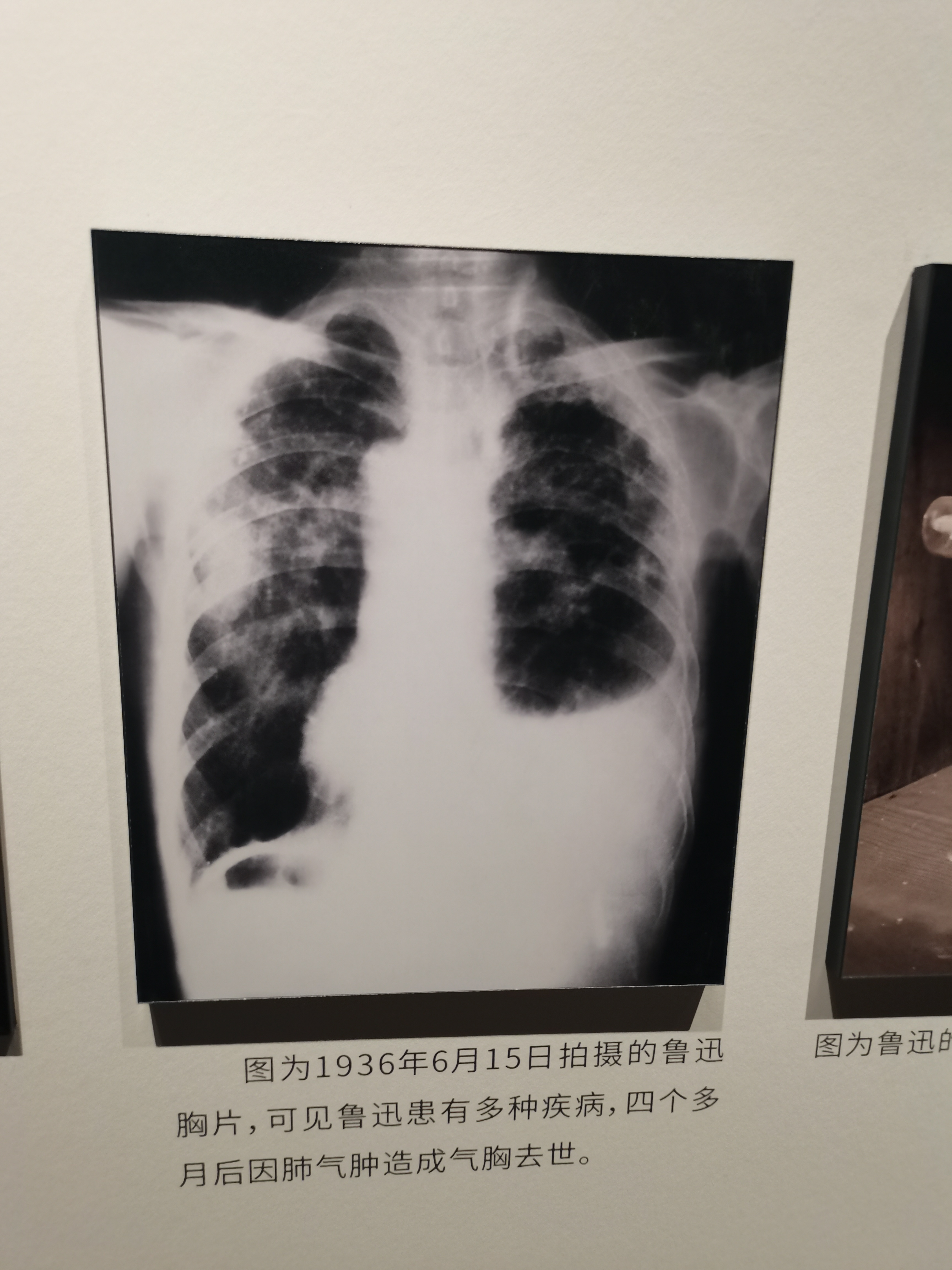 这个是鲁迅病危时的x光片,肺部感染
