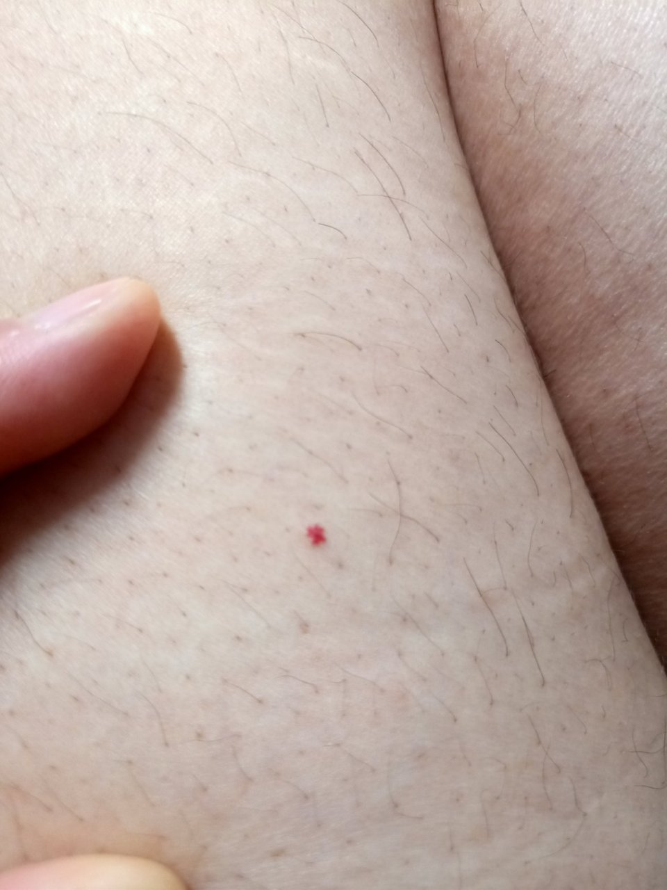 这是什么血管痣,还是血管瘤哪位懂的大神告诉一下谢谢.