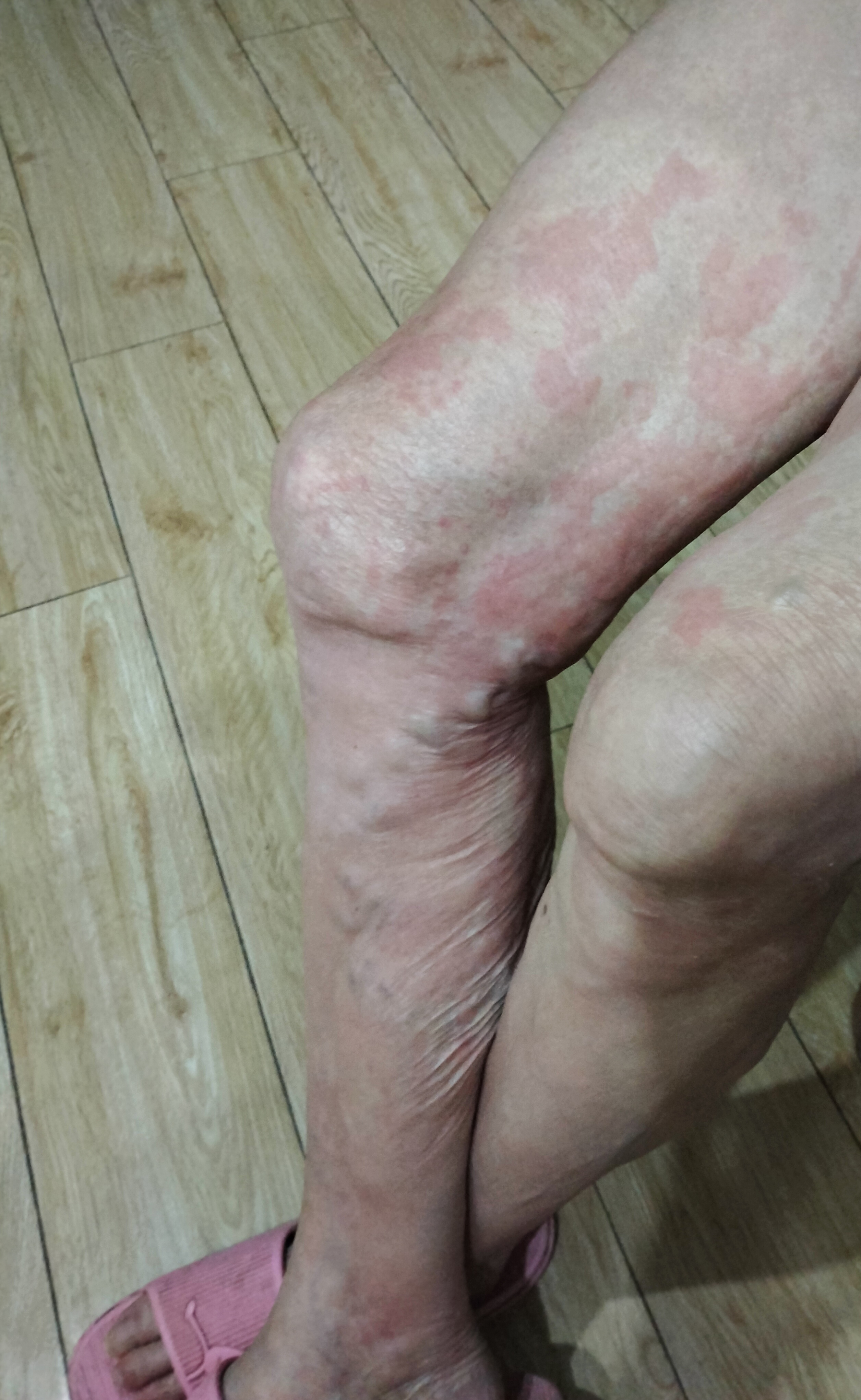 这一两个月婆婆身上好几次起疙瘩了,一开始说是过敏,鱼虾发物都不吃了