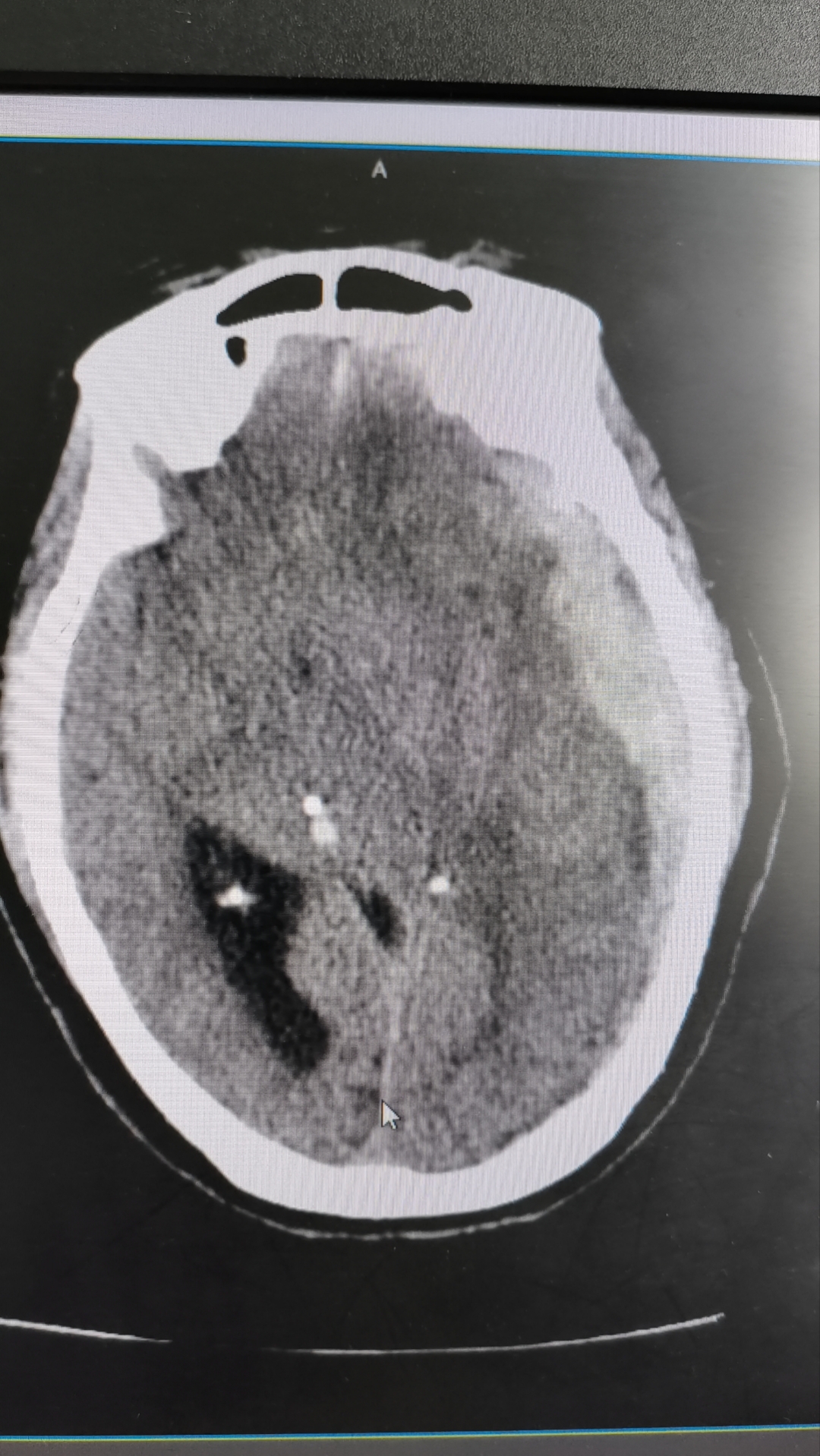 北京胸科医院核磁加急-北京胸科医院拍ct需要预约吗 