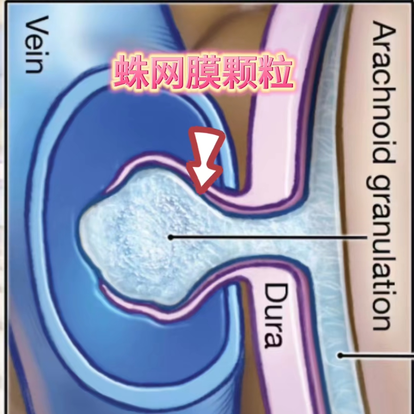 蛛网膜颗粒压迹