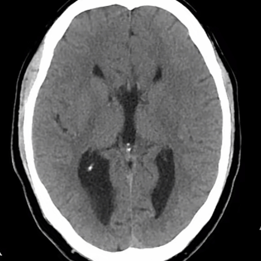 伴脂肪瘤是胼胝体发育异常和脂肪瘤并存,是最常见的颅脑先天性畸形