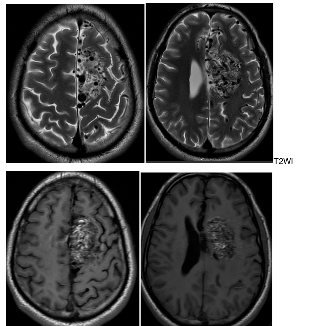 胼胝体动静脉畸形