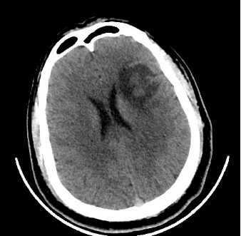 弥漫性星形细胞瘤