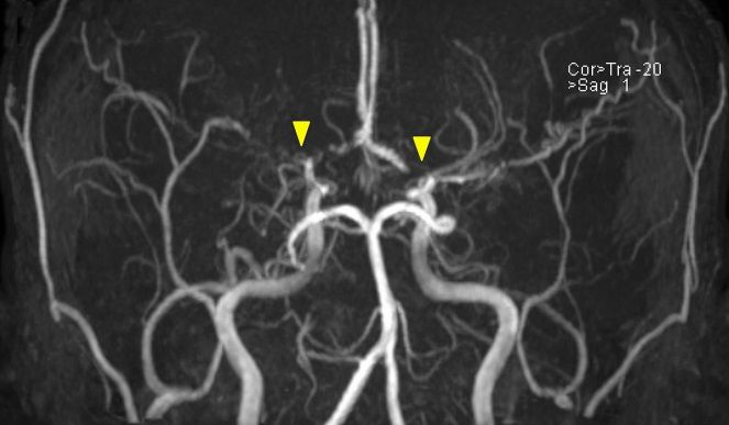 烟雾病又称颅底动脉环闭塞征