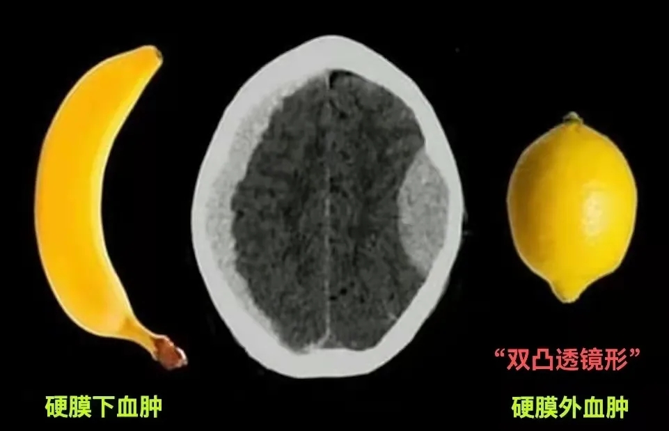 新月征,硬脑膜下血肿