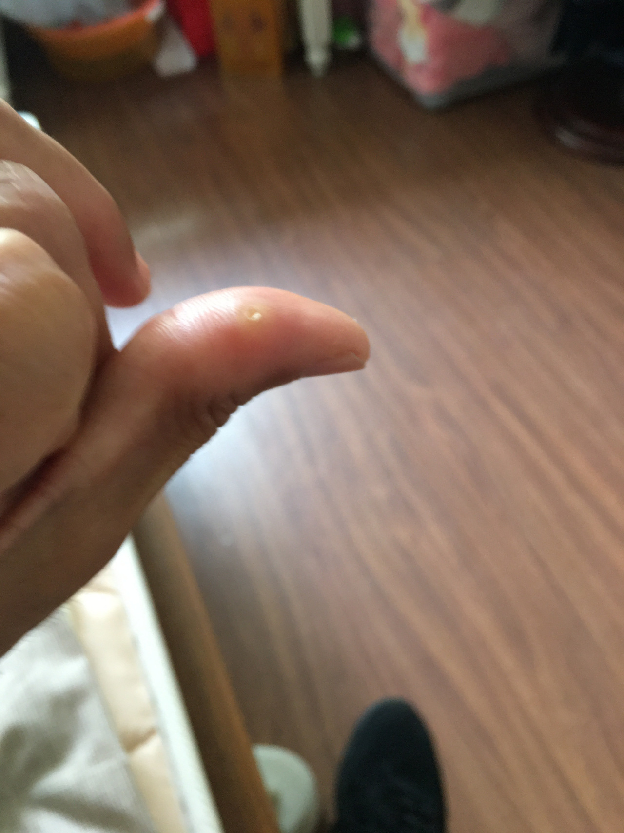 这是什么皮肤病,两手掌赤白肉际经常出现,痛几天就脱落好了