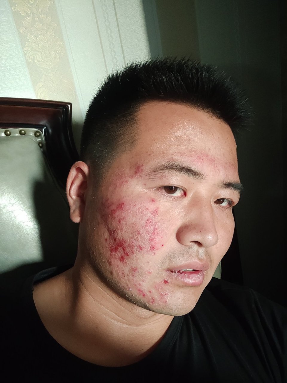 一脸都是扁皮尤怎么治疗