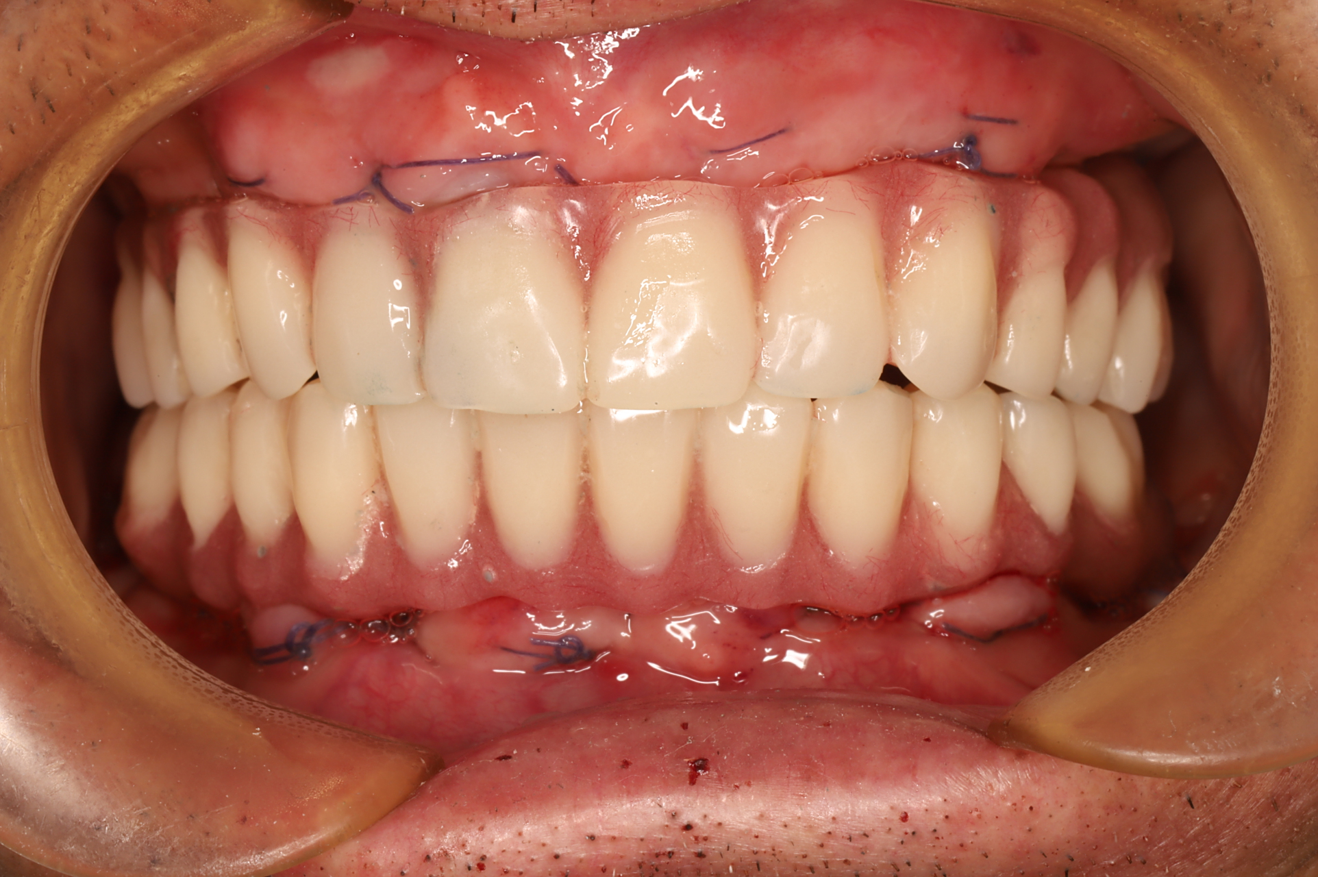 的饮食习惯以及生活方式的问题,所以导致自己全口的牙齿非常的不好