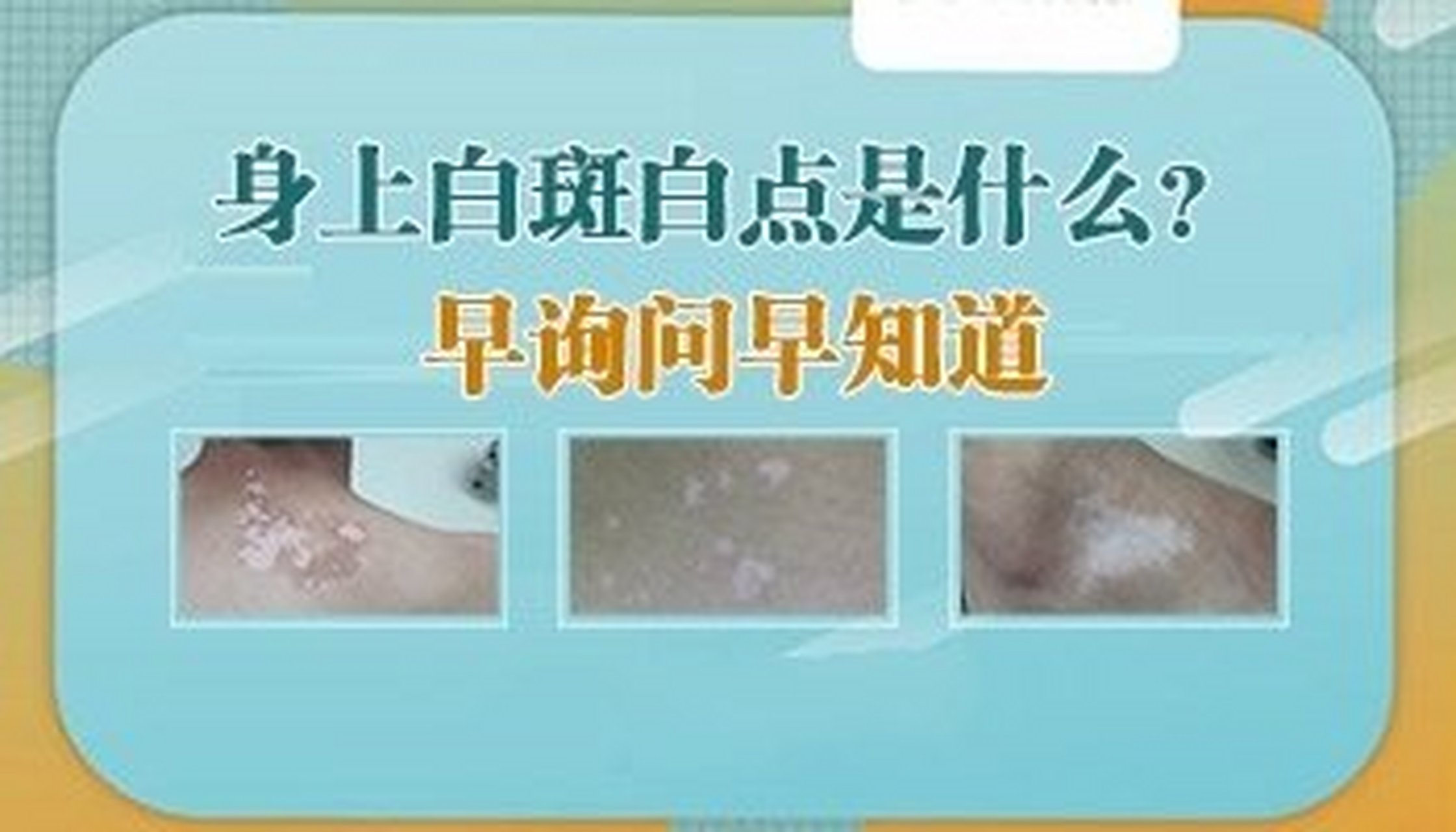 特發性白斑有什麼症狀?