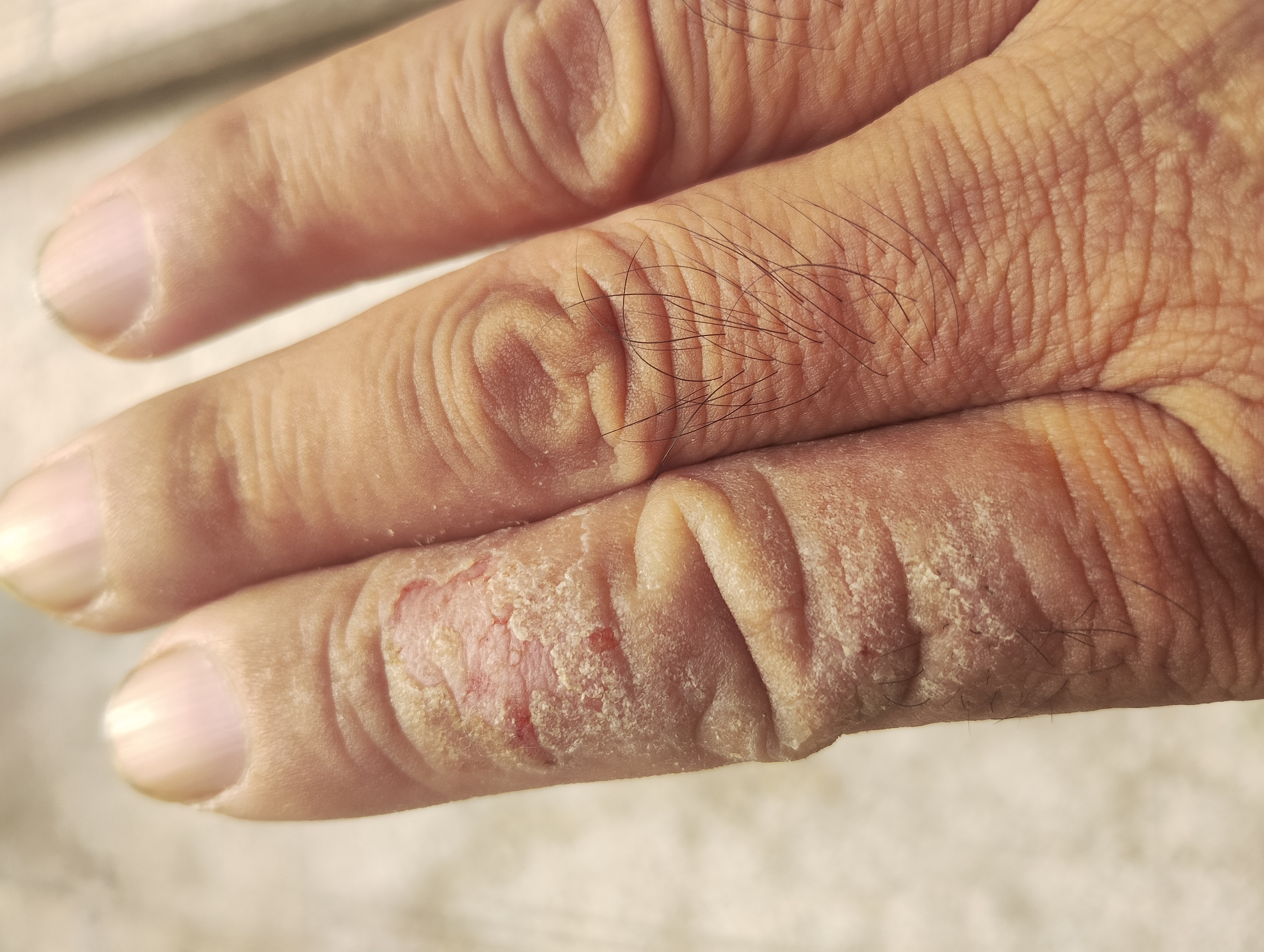 谁能把我这个手治好了我给谁一万,两个手都是这个手指头上痒,一挠就会