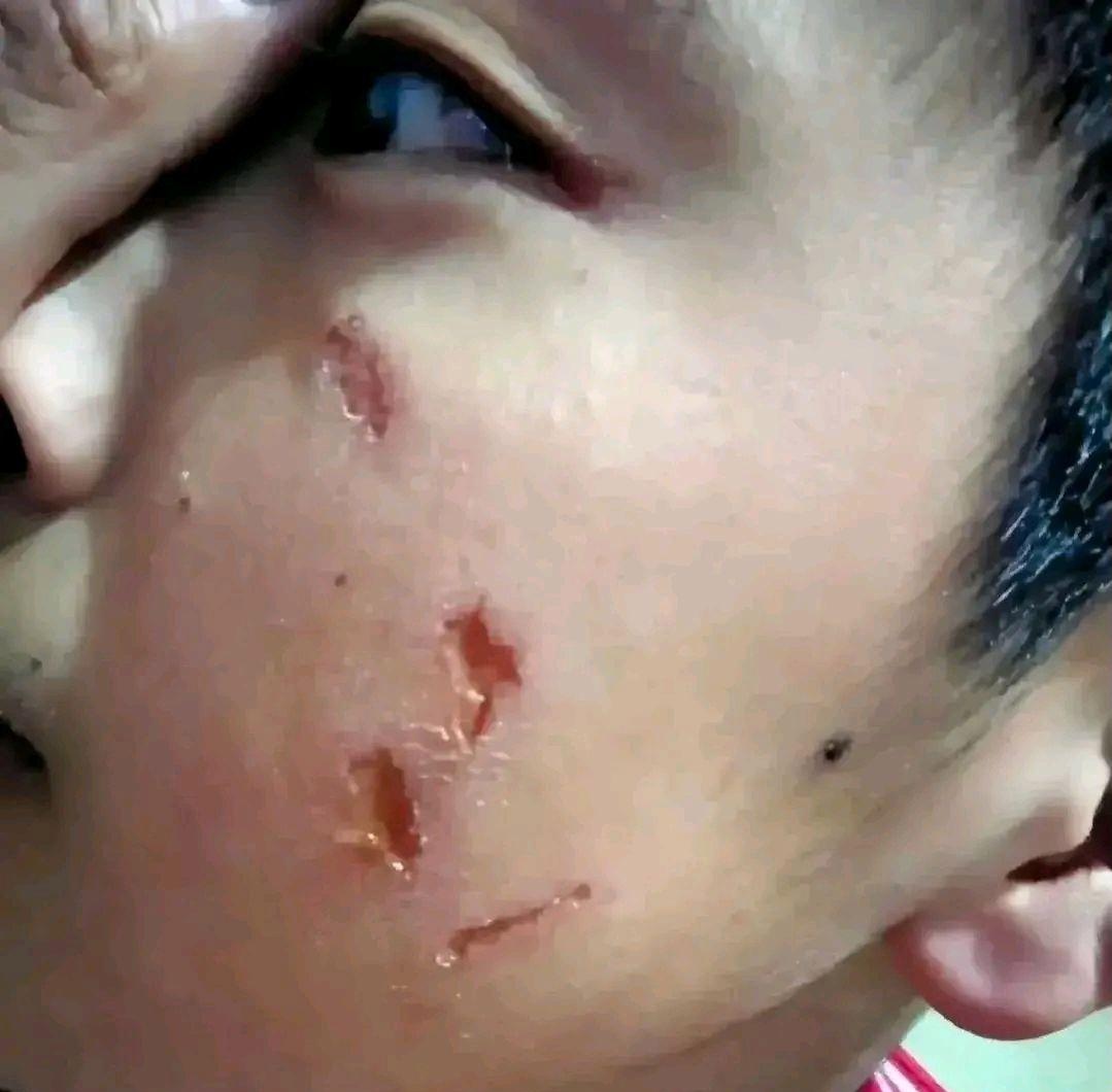 孩子之间有矛盾很正常,男孩调皮打架也能理解,但是脸被抓成这样,太不