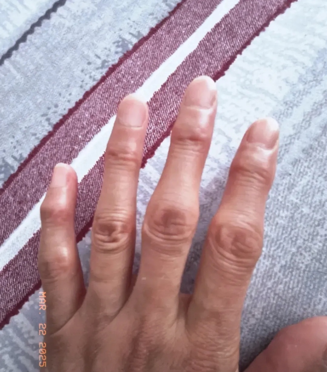 我家妹妹今年48岁,得了类风湿性关节炎,目前双手严重变形,手指不能