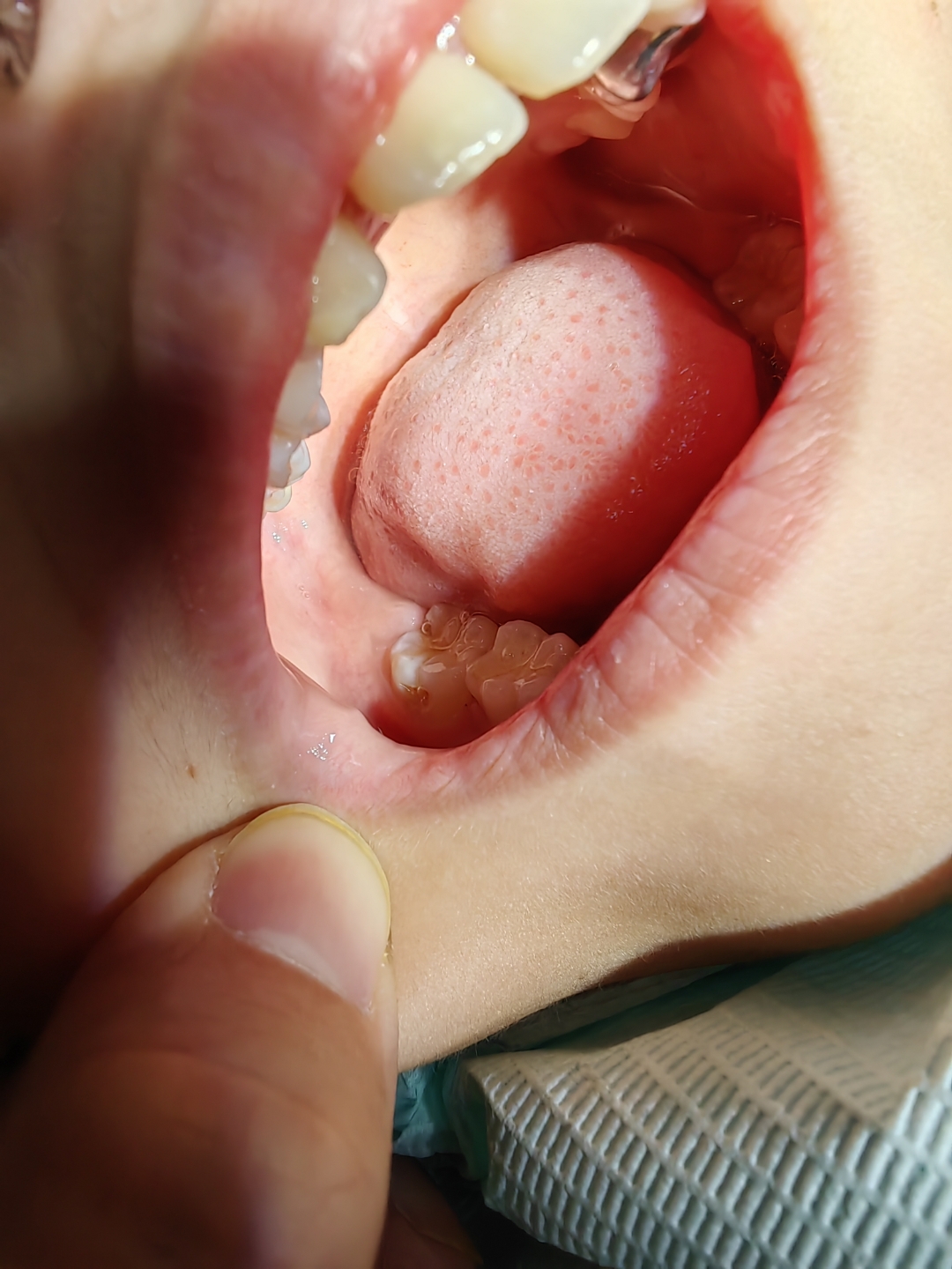 两颗恒牙受损,需及时修补保护. 所以,小朋友们要注意牙齿清洁