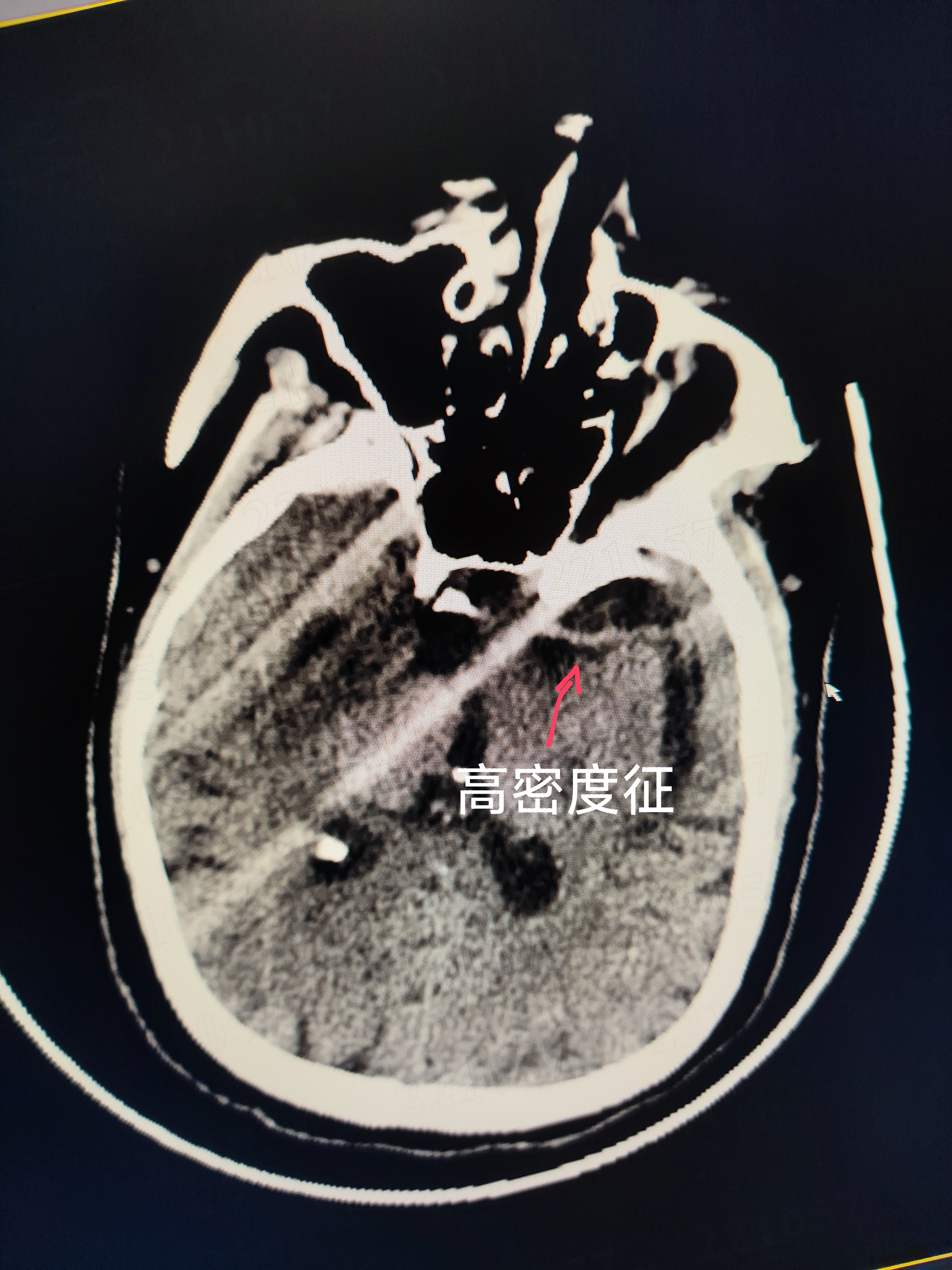 颞叶钩回疝ct图片图片