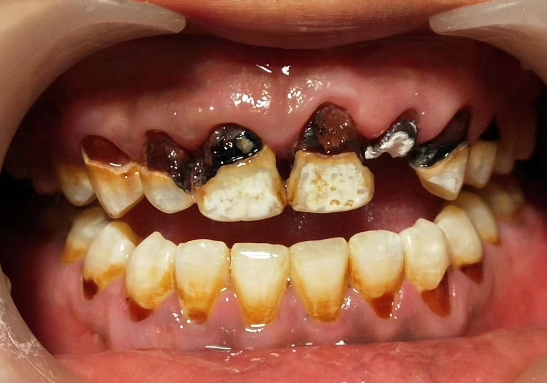 爱美之心人皆有之,只要用心,烂牙也能重获新生,爱护牙齿,从细微处着手