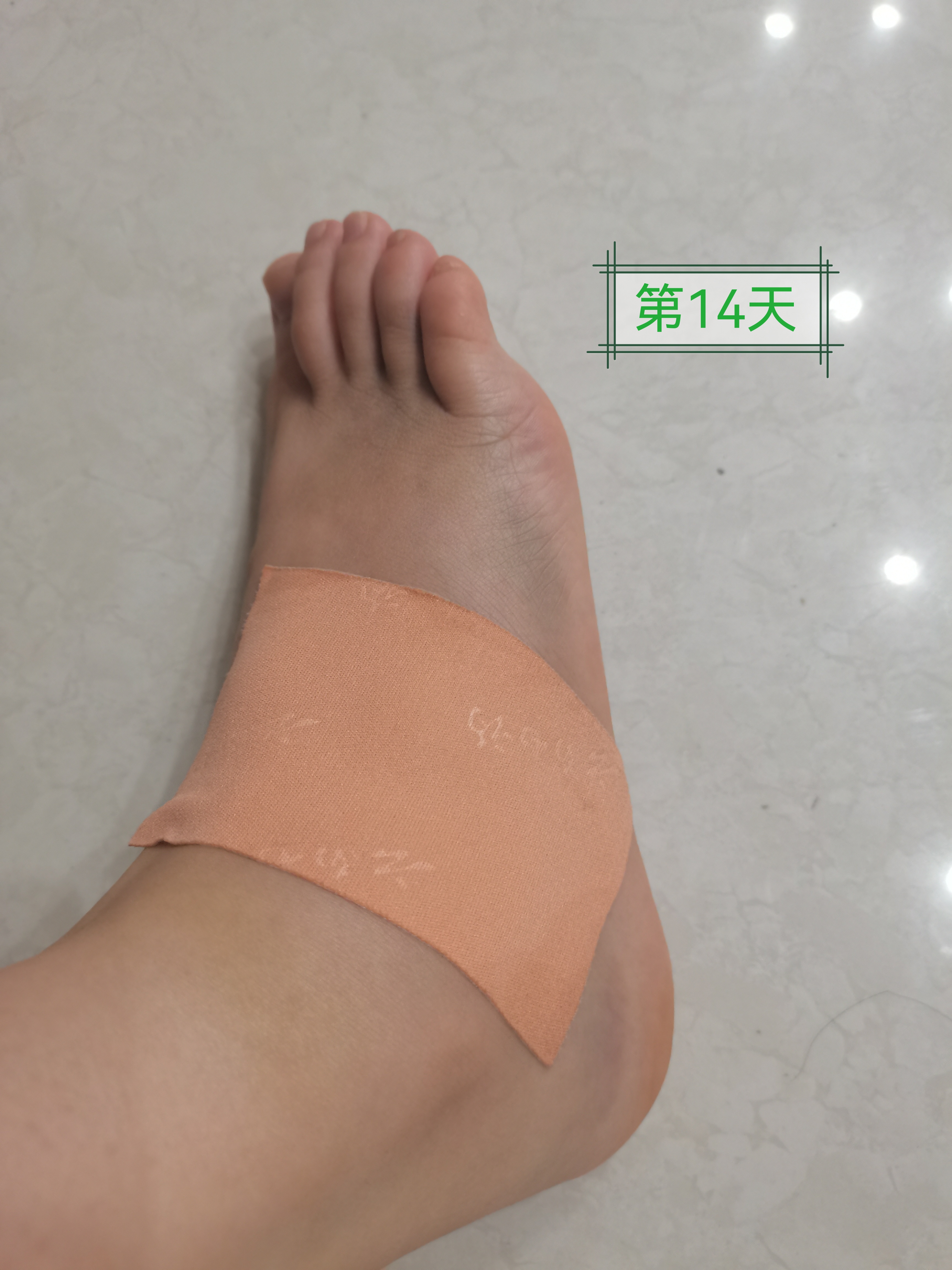 崴脚十几天了,现在还没有完全消肿,啥时候能好啊?