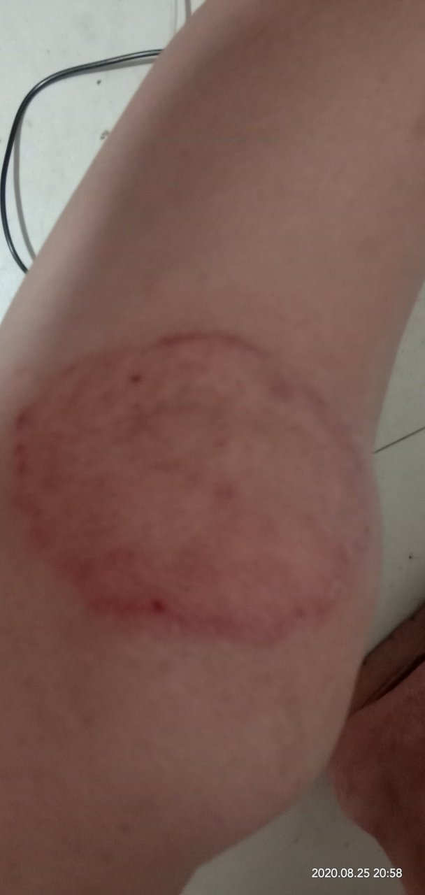 铜钱癣该怎么治