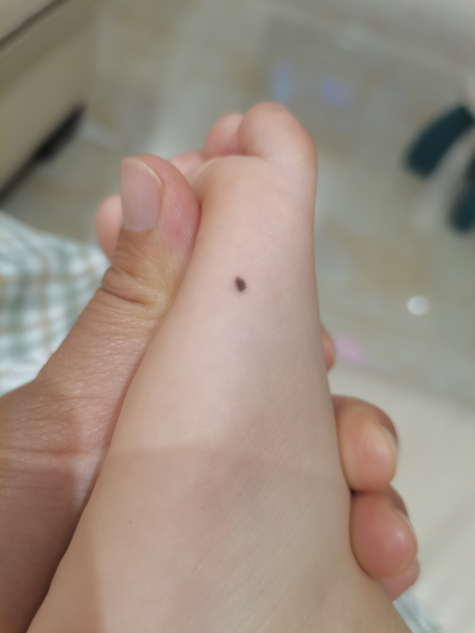 男宝宝左脚侧面长痣 懂的人帮忙看下