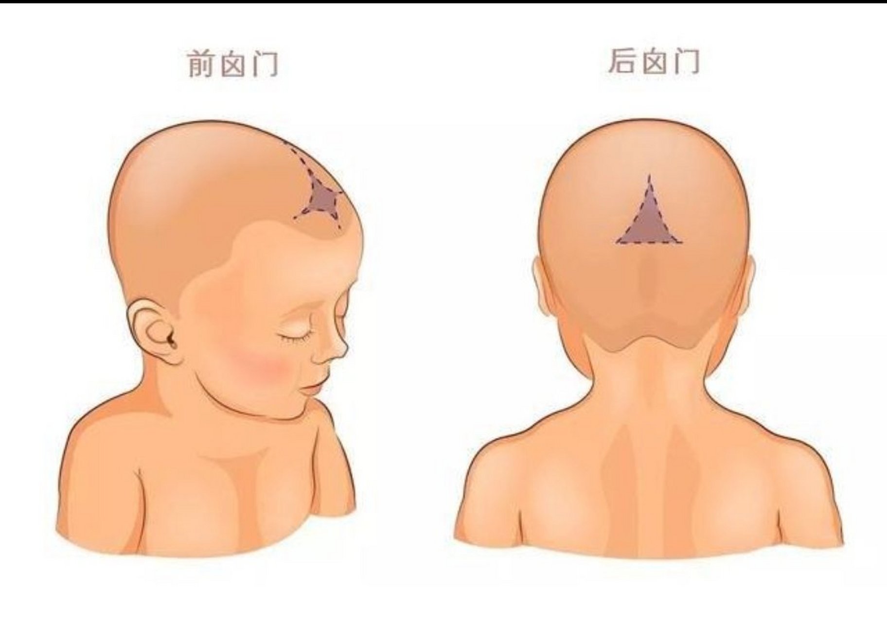 今天,有家长咨询,如何判断孩子卤门有没有闭合呢?