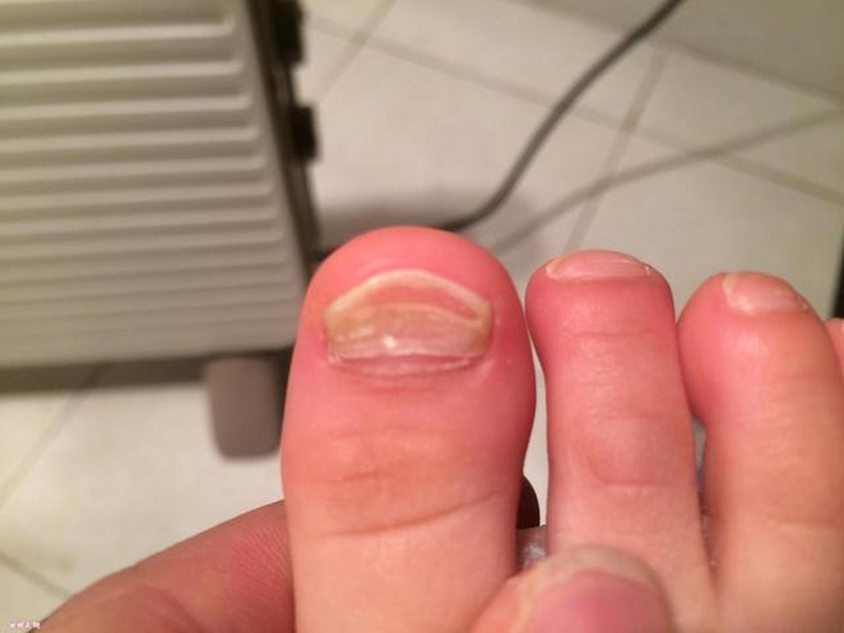 一般情况下,宝宝的脚趾甲出现分层断裂现象,可能是因为宝宝挑食营养