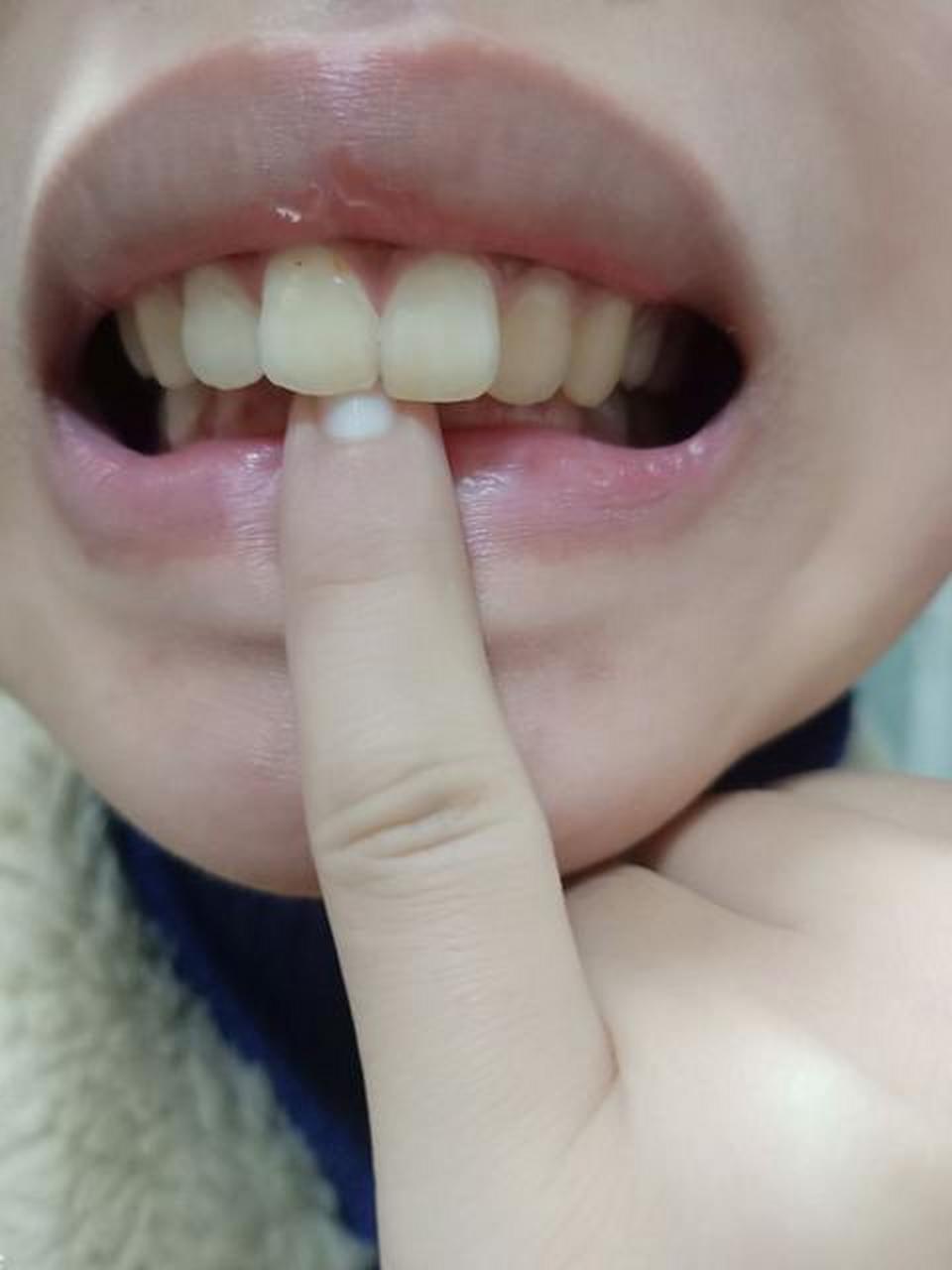 宝宝牙齿天包地,就是上牙包住了下牙.