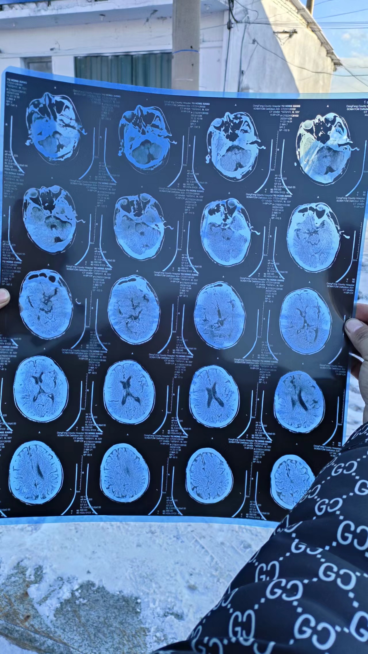 大家帮忙看一下 这个脑部ct   情况严重不