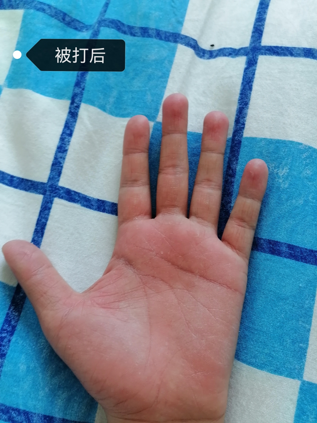 考试考砸了放假回家被打手心50下,打的挺用力的,现在手又红又肿握拳